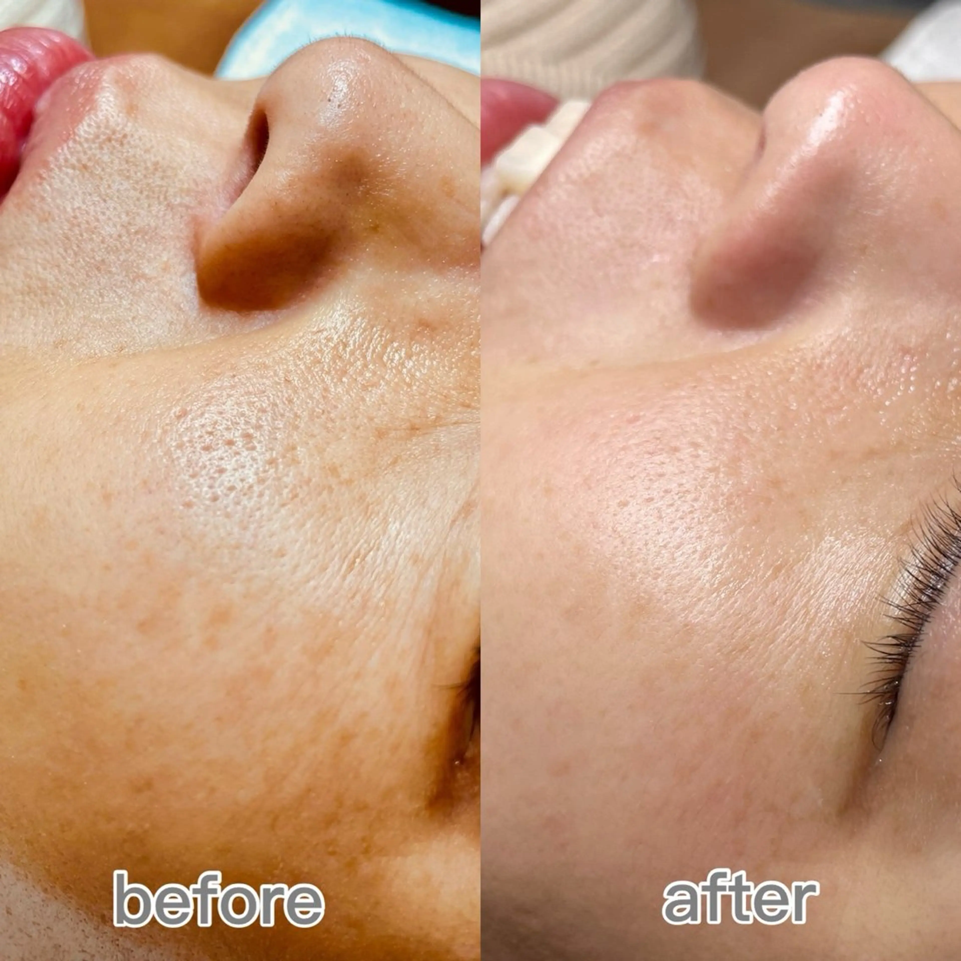 艶肌フェイシャルWAX1回+鎮静パック　ツヤツヤもちもちたまご肌への写真