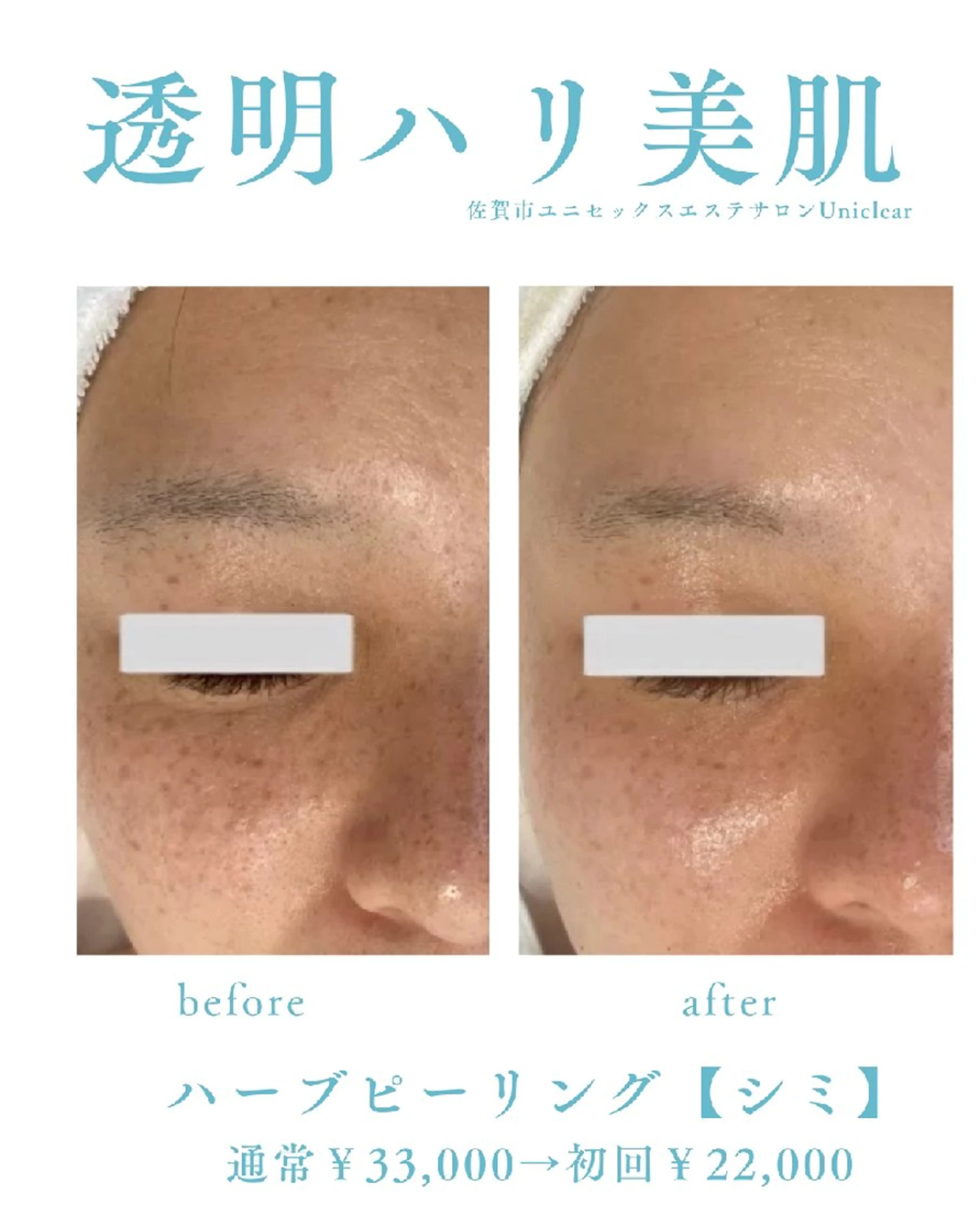 【シミくすみ必見】高級ハーブピーリング&IPL照射の写真