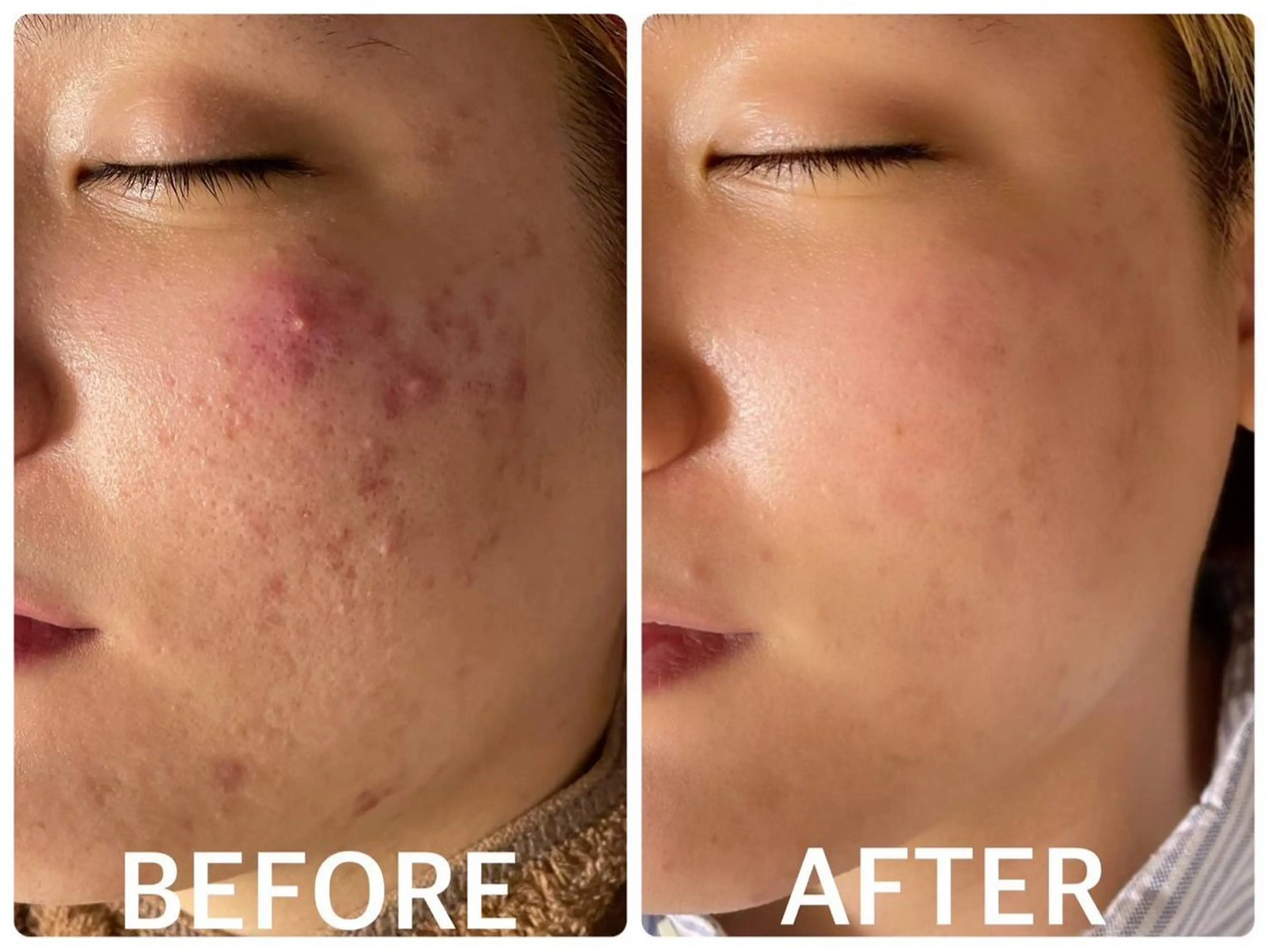 ハーブピーリング 🌿京橋のエステ・リラクイメージ