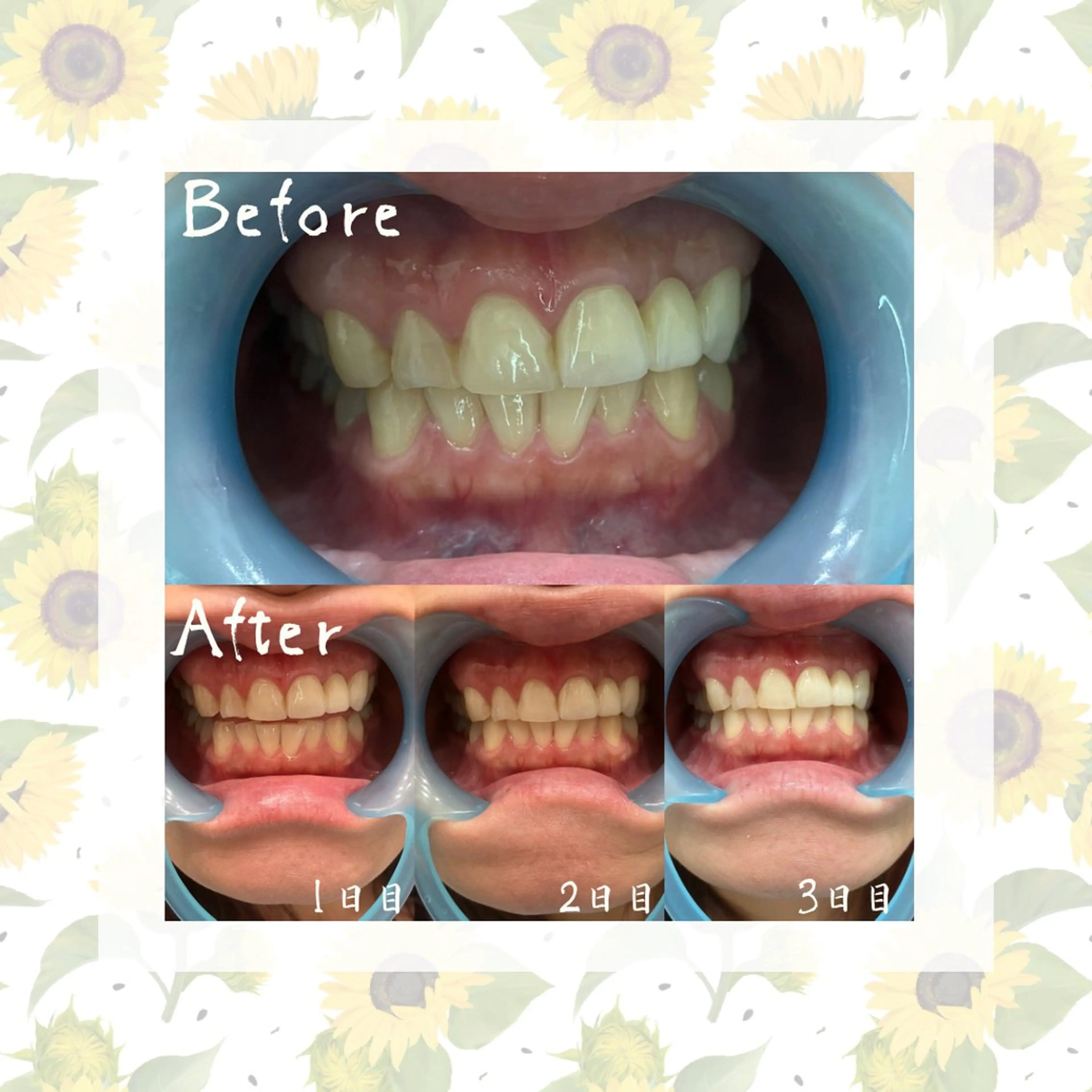 セルフホワイトニング 『Luster』のその他イメージ