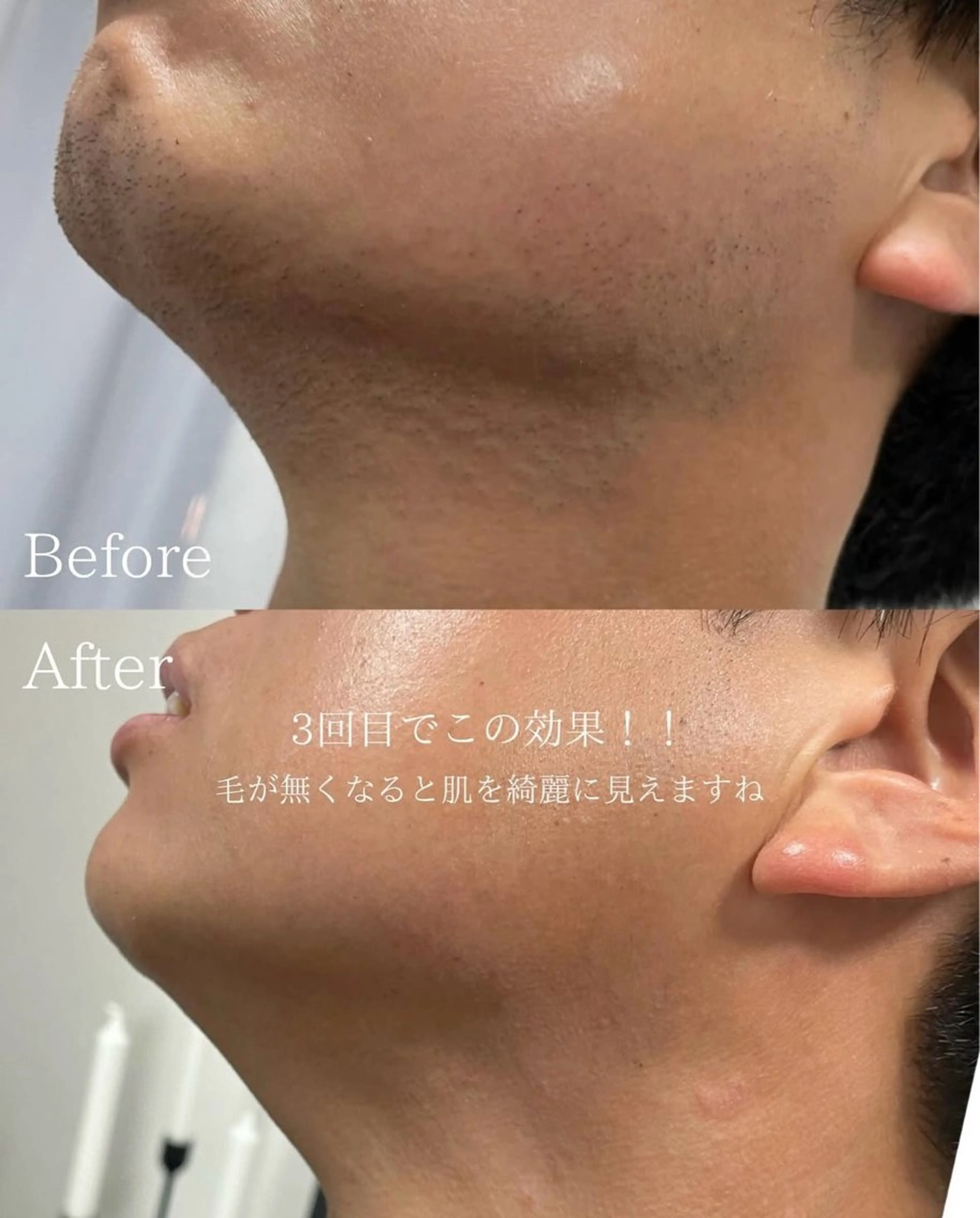 🔥10/19限定価格🔥🔰【超🉐初回体験】しっかりカウンセリング👍✨脱毛ワンパーツ(髭/腕/脇など)✨の写真