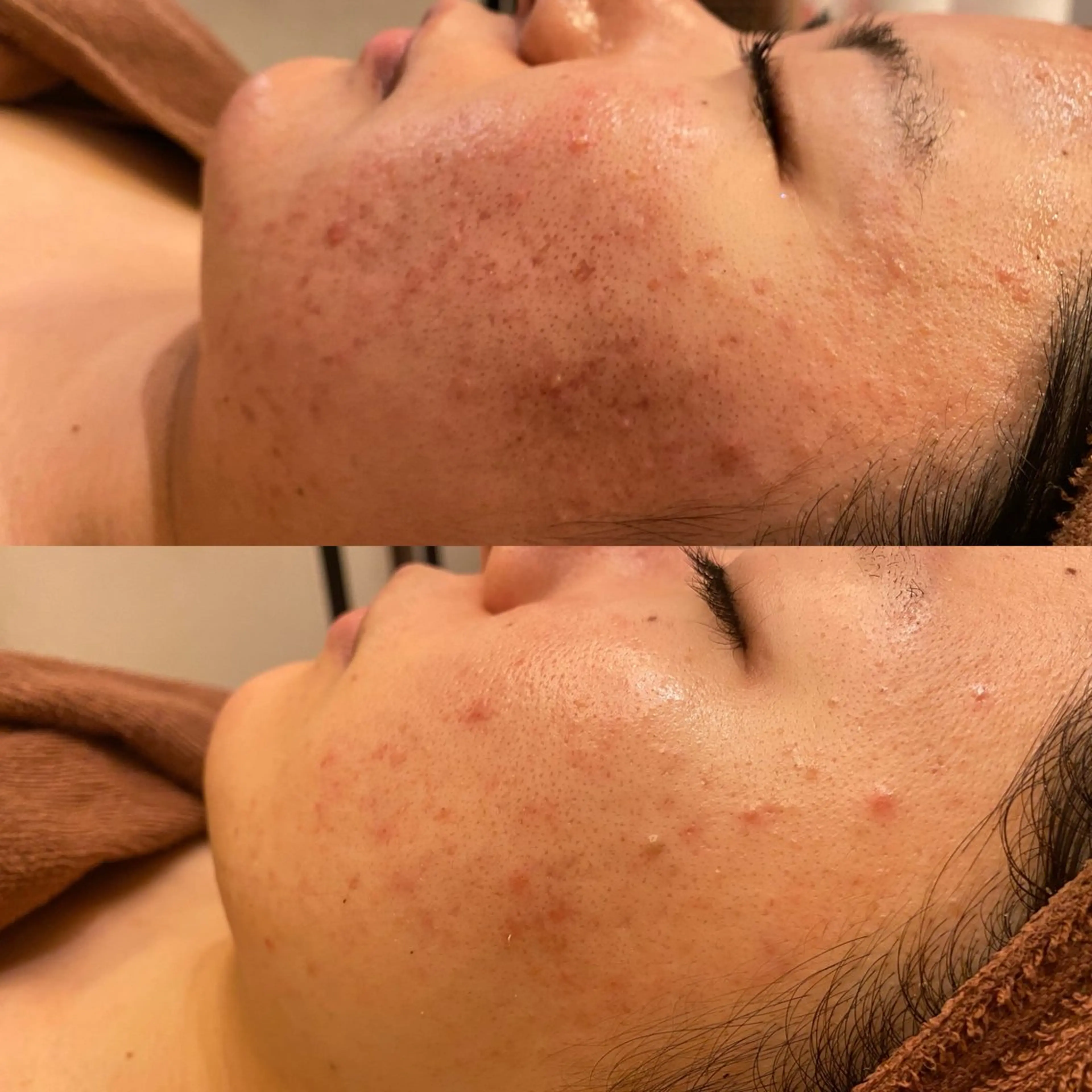 ハーブピーリング/韓国肌管理/フェイシャル/毛穴洗浄/眉毛/顔脱毛【糸脱毛専門】rev所属・ハーブピーリング🌹 毛穴洗浄❤️眉waxのエステ・リラクイメージ