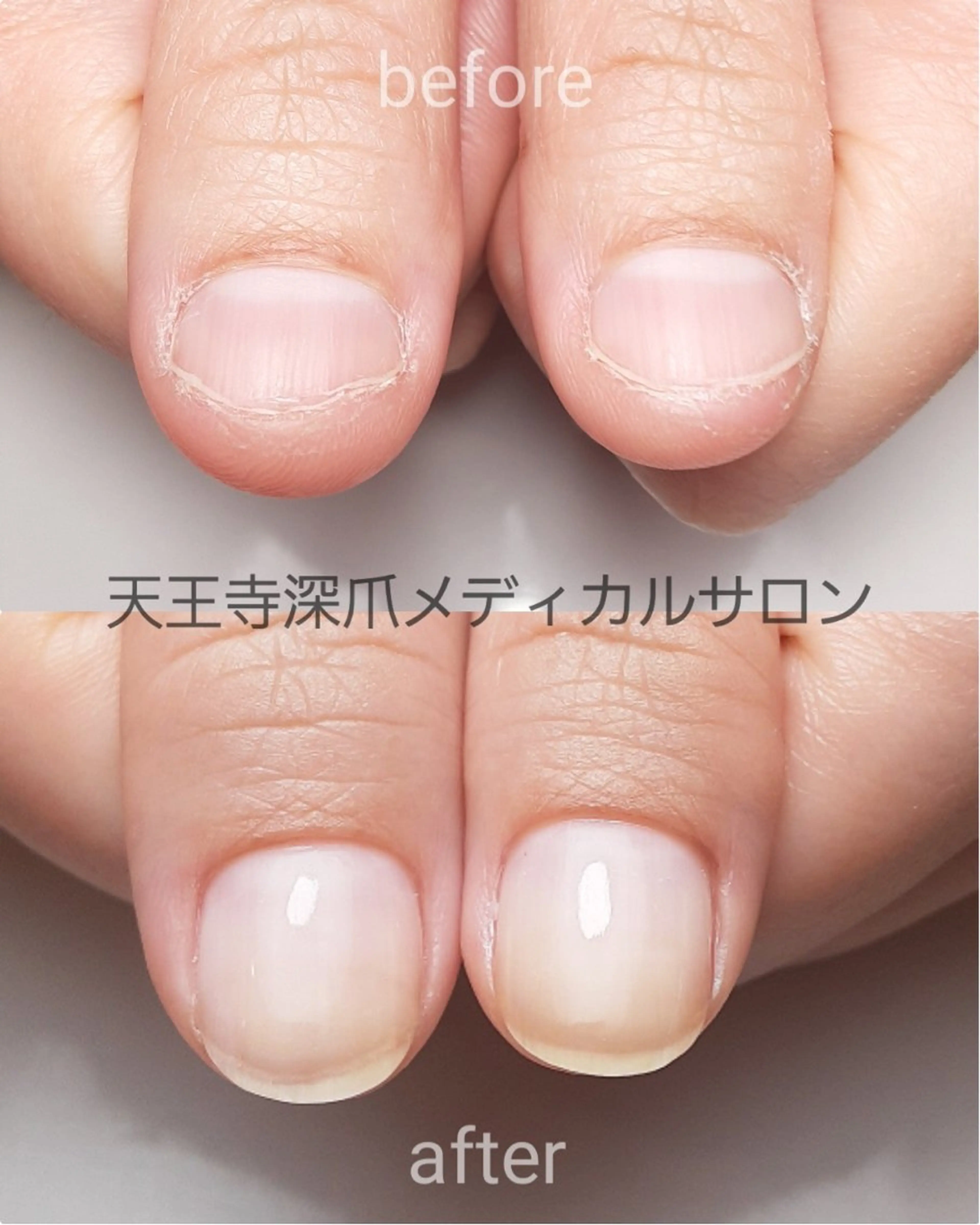 ネイル 天王寺 深爪メディカルサロンのネイルデザイン