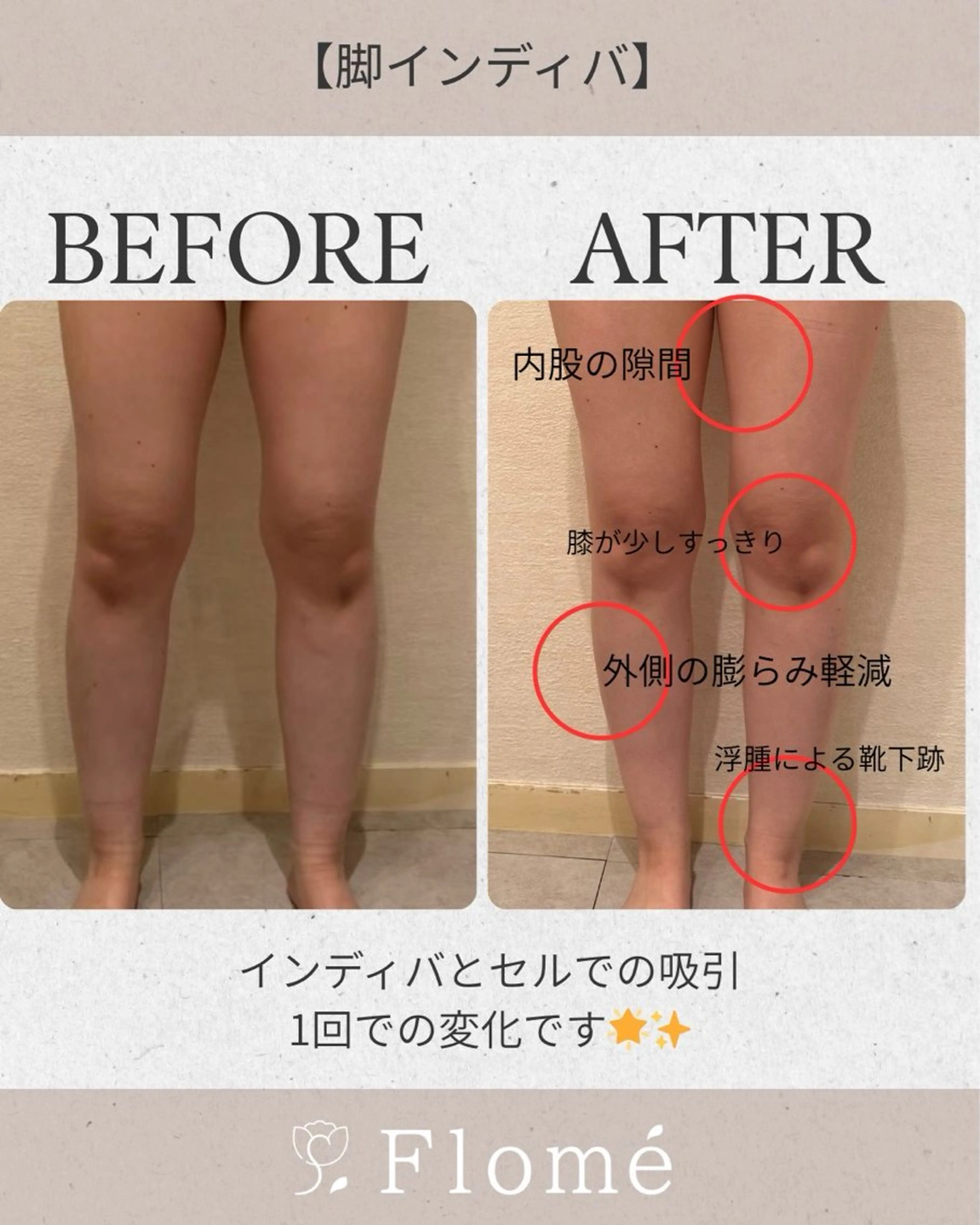 【女性限定】全身スッキリコース🎀よもぎ蒸し→腸もみ→痩身(二の腕・お腹・脚)→耳ツボジュエリーの写真