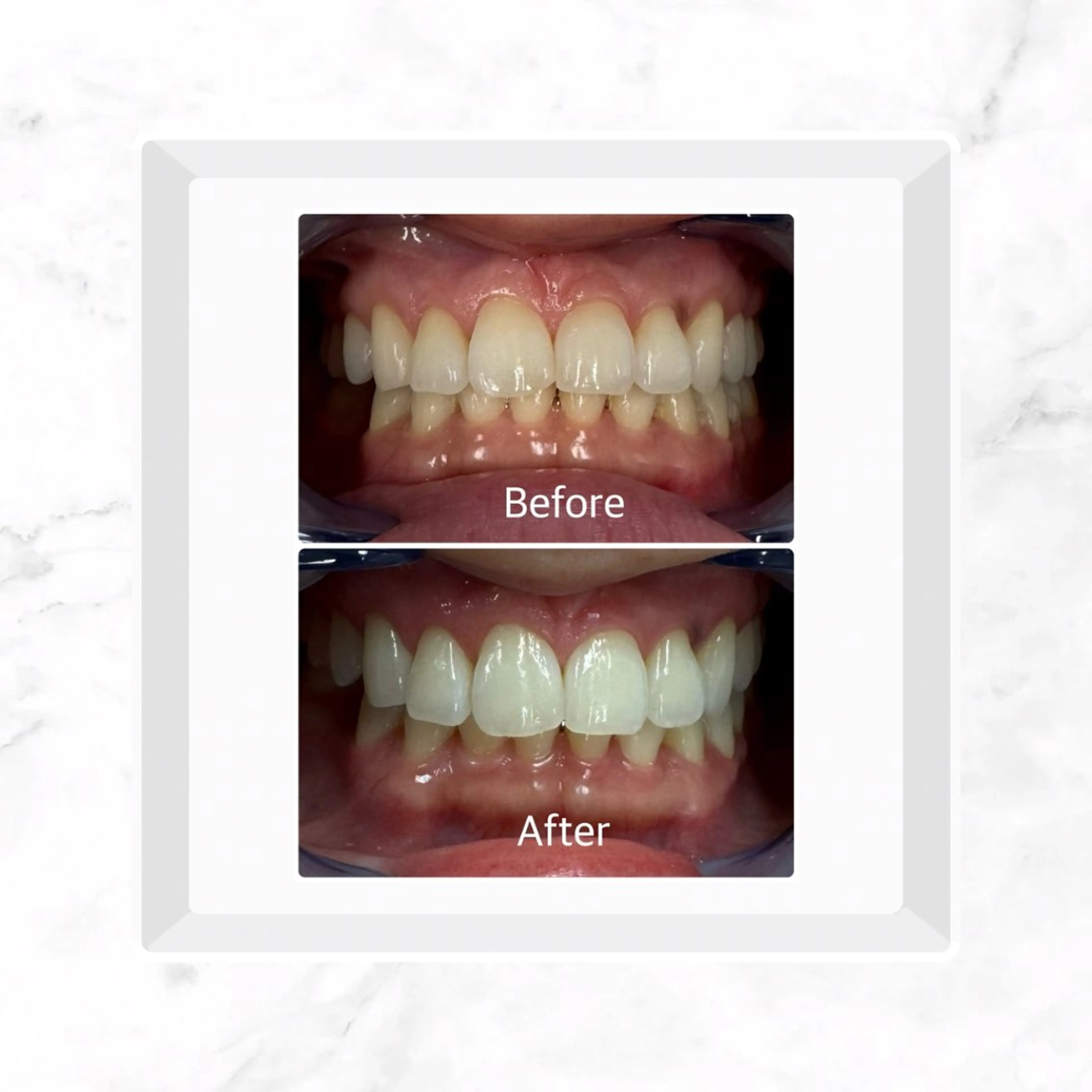 セルフホワイトニング　10分×2照射の写真