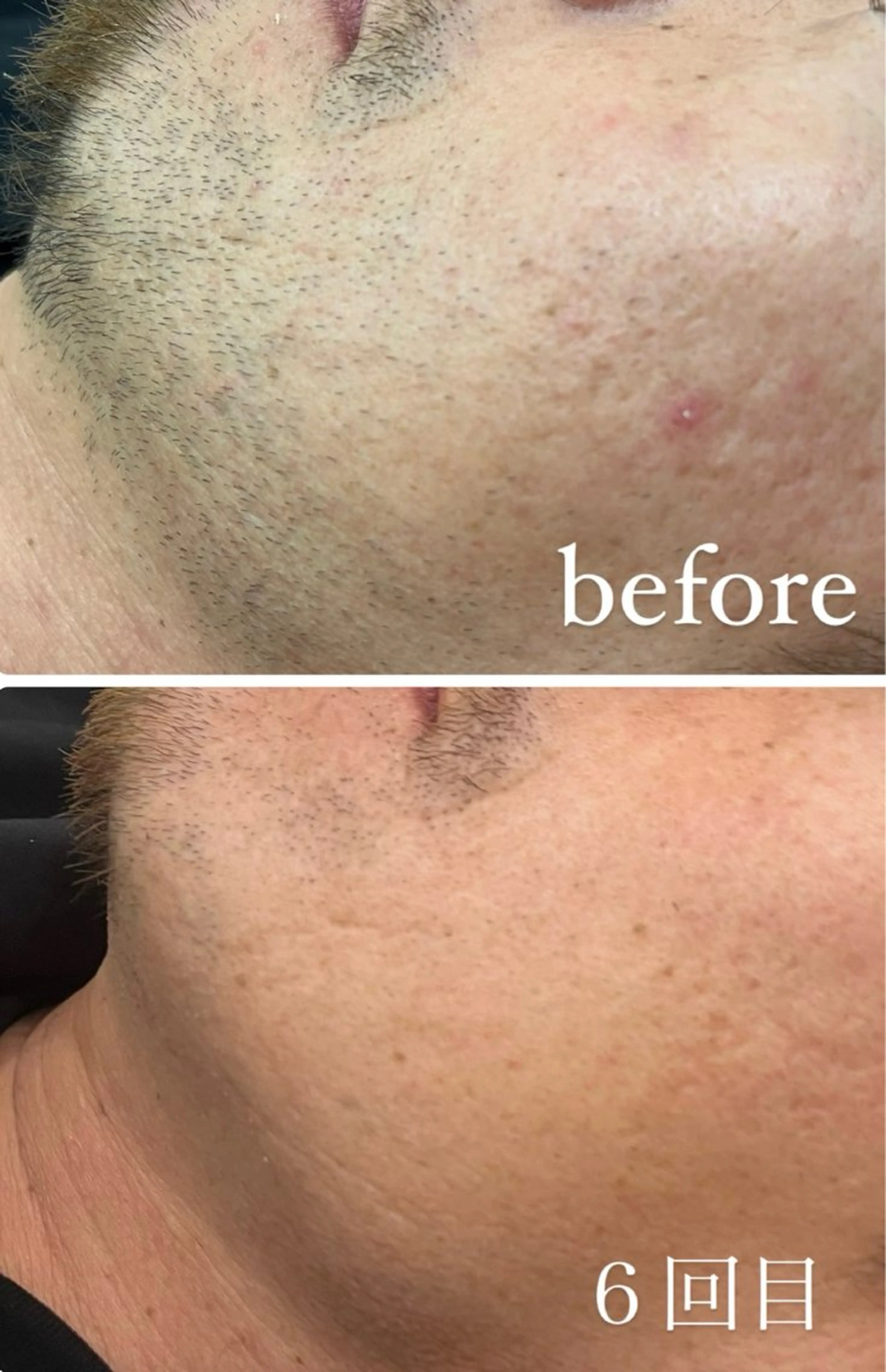 【安心都度払い】men'sヒゲ脱毛お試し1回🩵ヒゲ脱毛はもう当たり前😌🌿脱毛しながらイオン導入で美肌効果🧔✨の写真