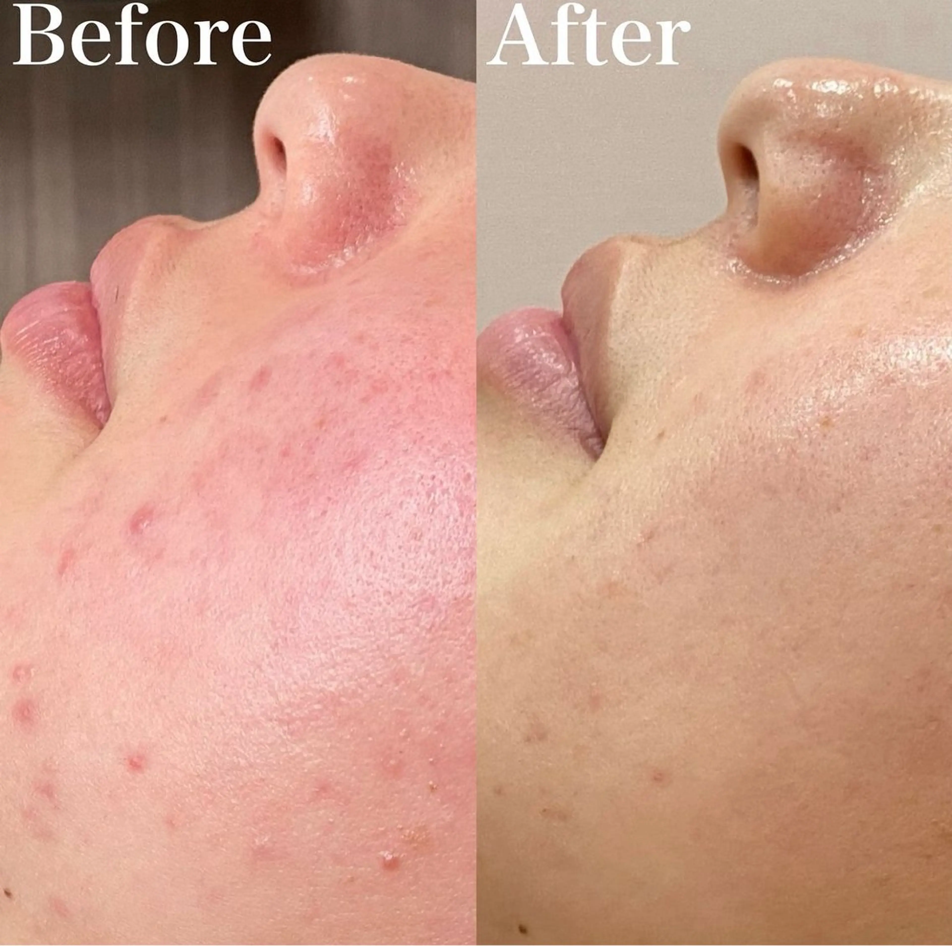 大人気！🌿REVIハーブピーリング🌿の写真