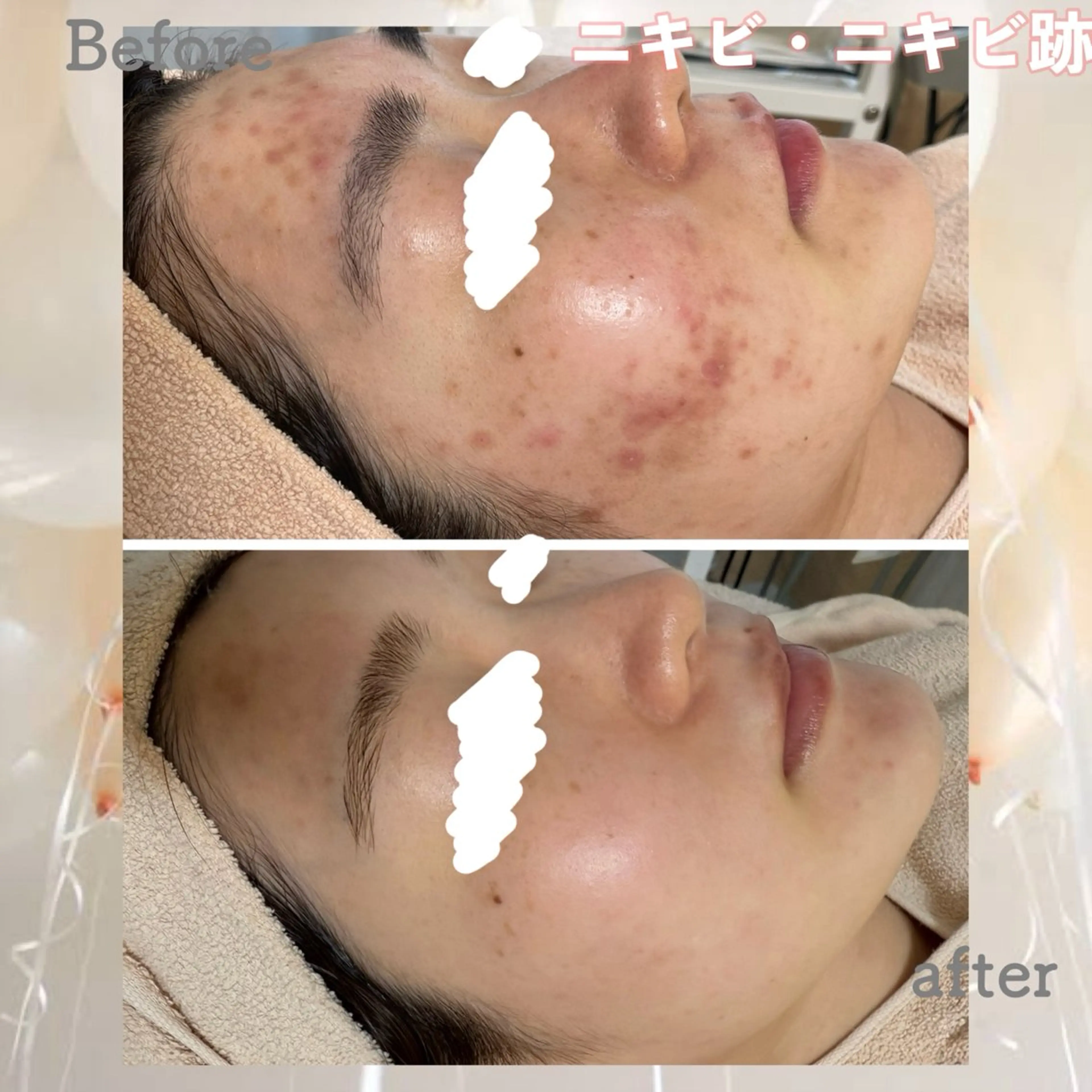 剥離ほぼなしハーブピーリング&保湿パック🌿の写真