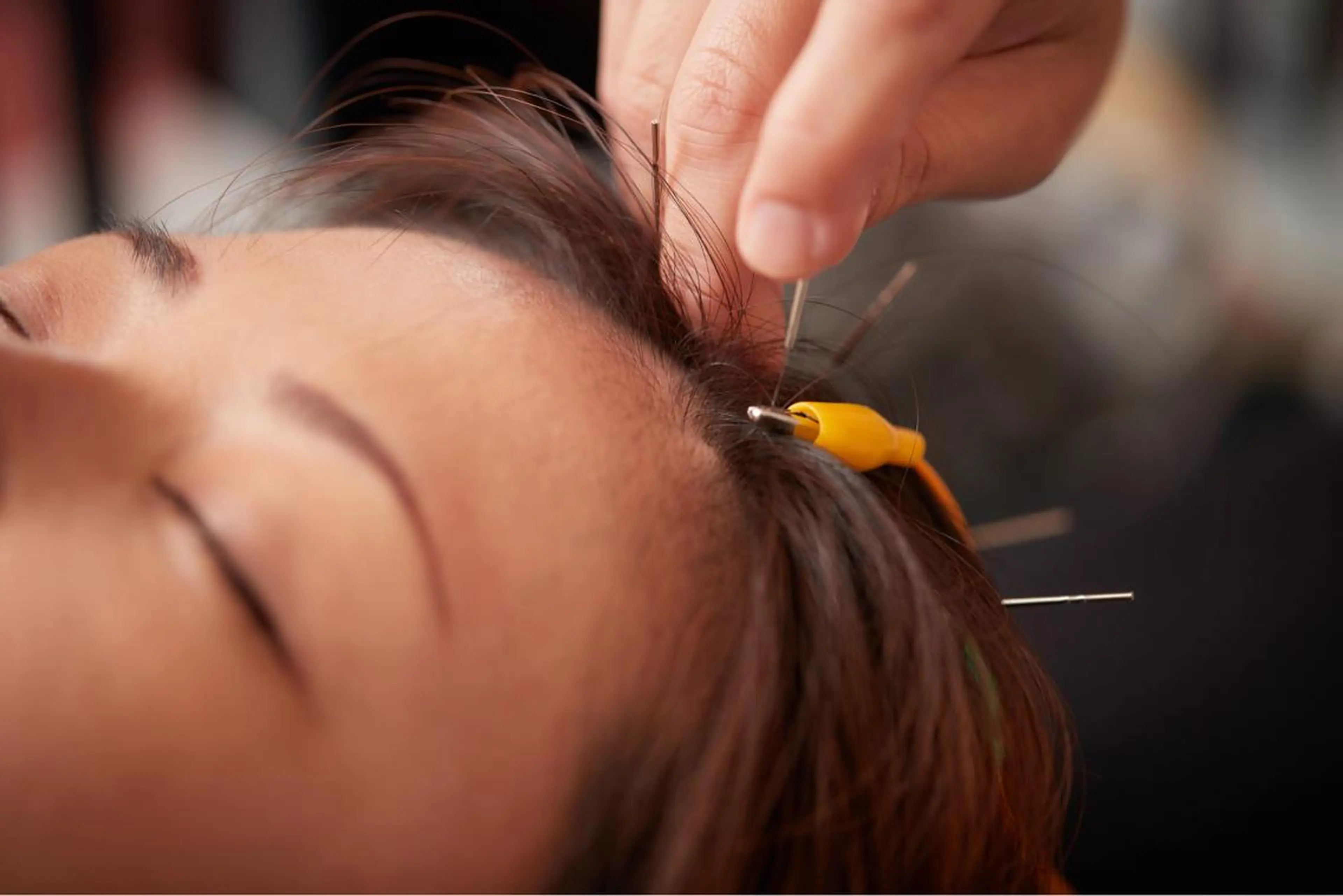 美楽鍼 びらくしんのその他イメージ