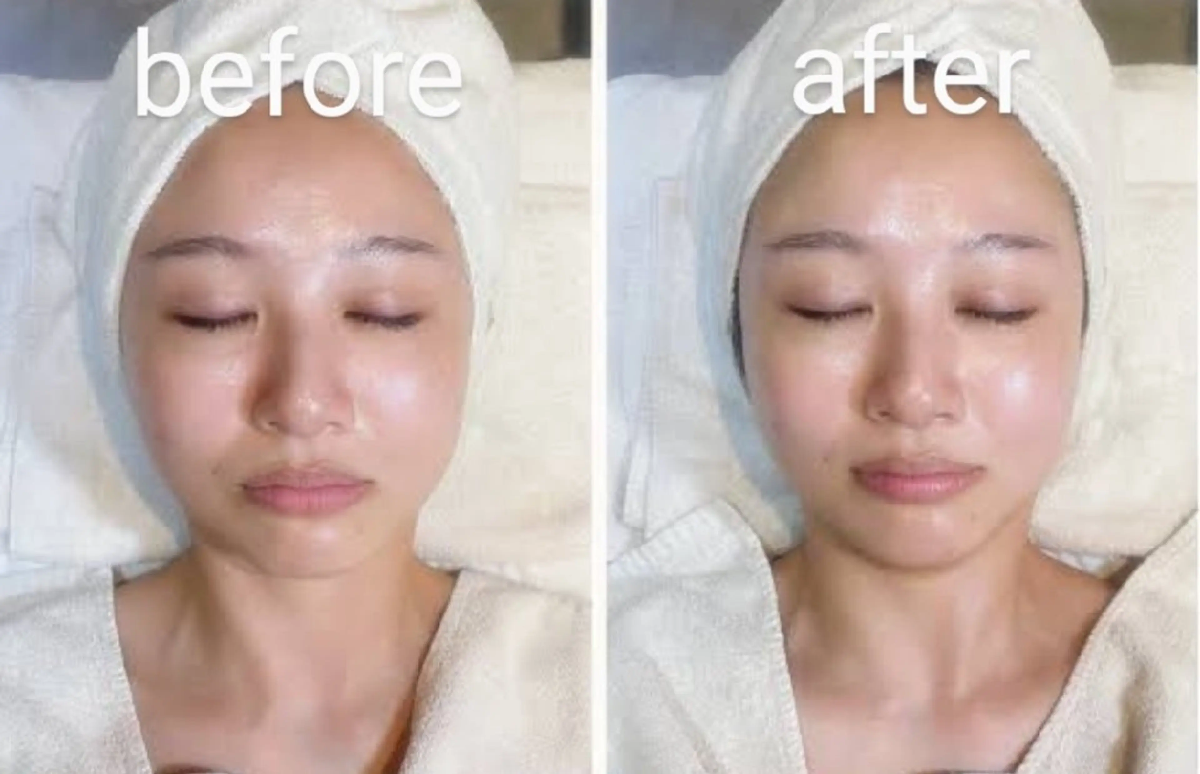 ハイドラフェイシャル+乳酸ピーリング（植物性由来のピーリングで肌の輝きと肌を正常なターンオーバーに促す！の写真