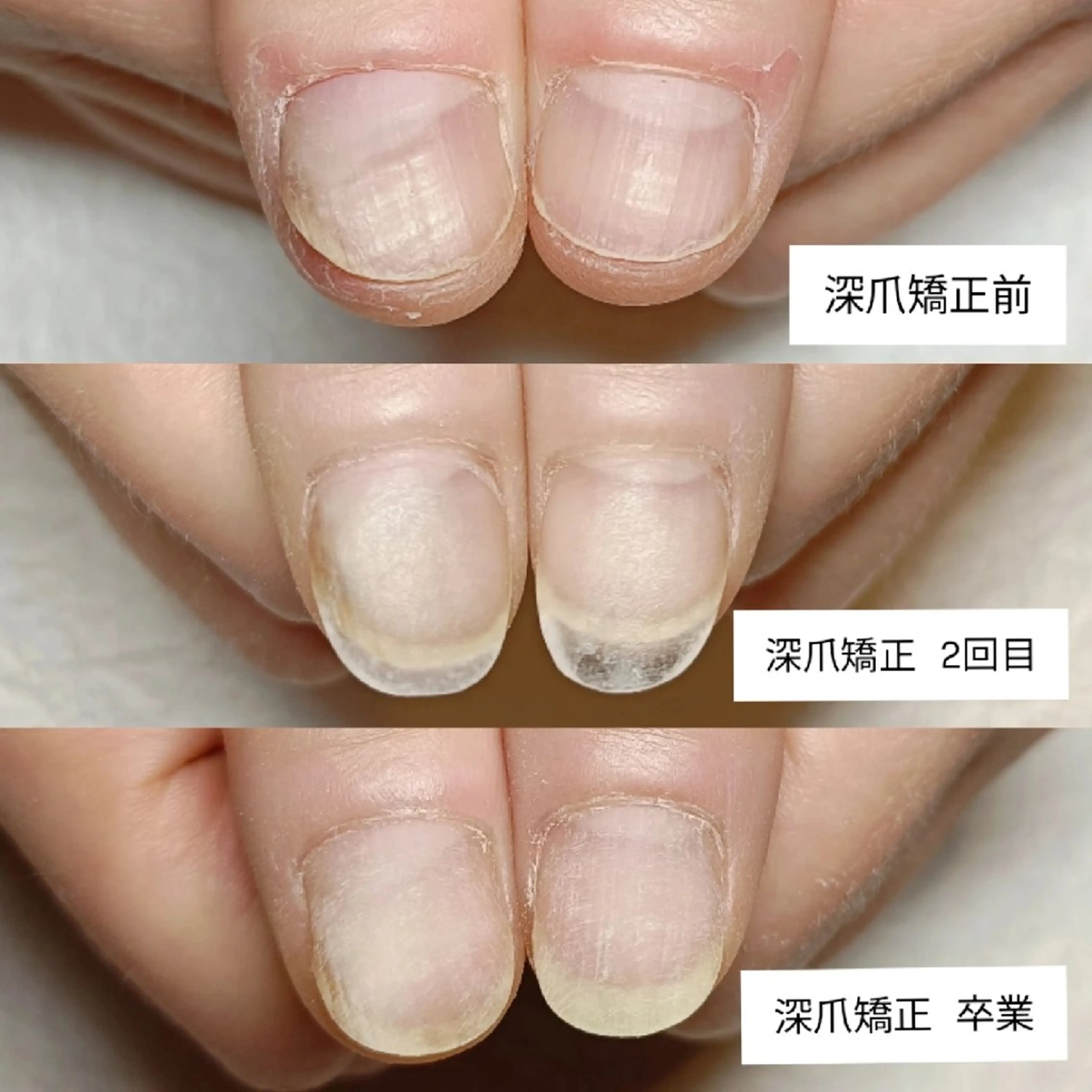 ネイル ハンドネイル ハンドケア 深爪矯正/爪育成ケア manie nailのネイルデザイン