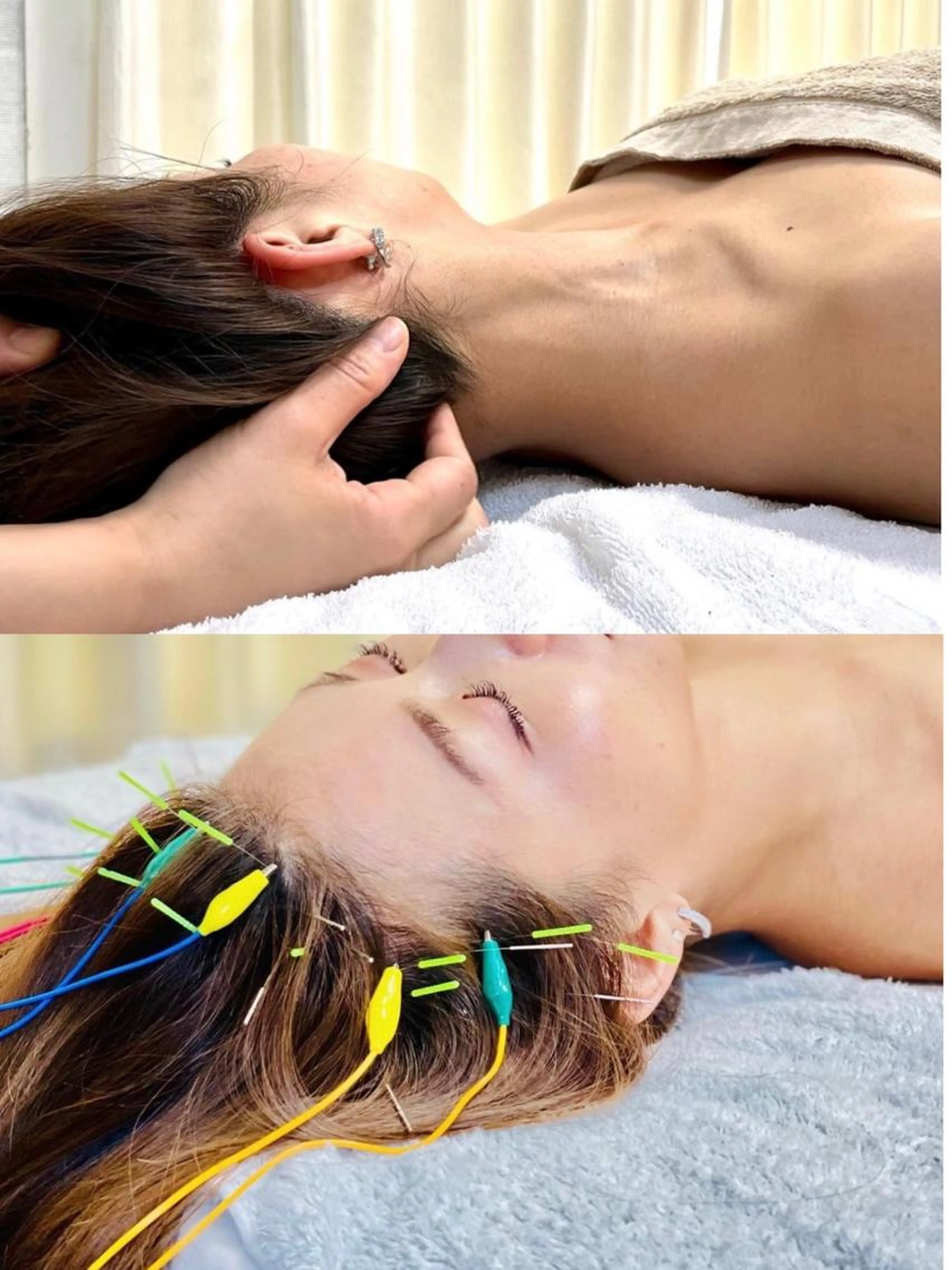 頭皮ガチガチ不眠、頭痛⭐️筋膜引き上げ頭皮鍼＋電気＋首顔温め＋首肩背中オイル、炭酸泡マッサージの写真