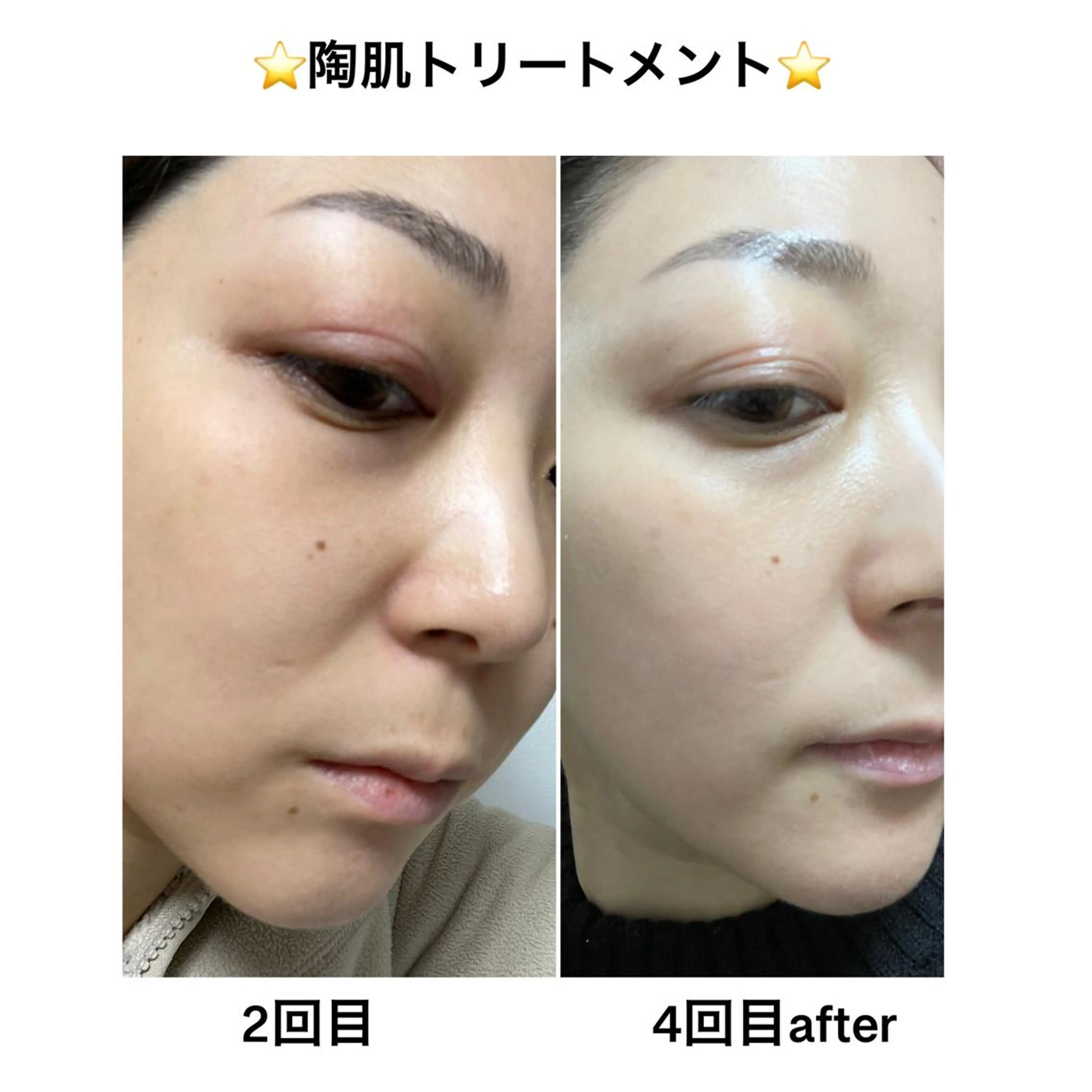 その他 アロマ•ピーリング SalonYokoのその他イメージ