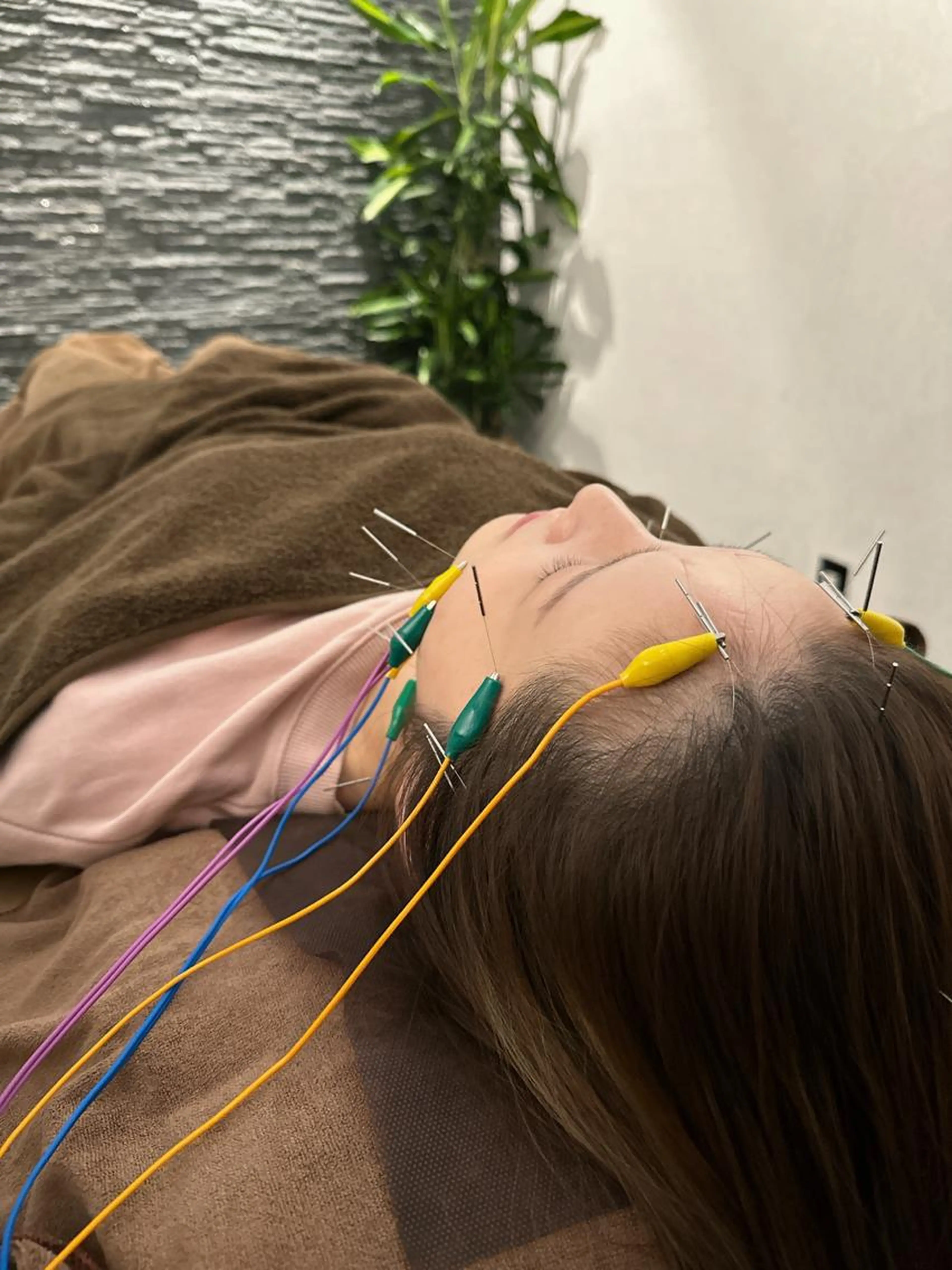 人気No.1🔥たるみ、リフトアップ、浮腫みに特化✨電気を流す美容鍼　通常料金12100円→7700円※カウンセリング込の写真