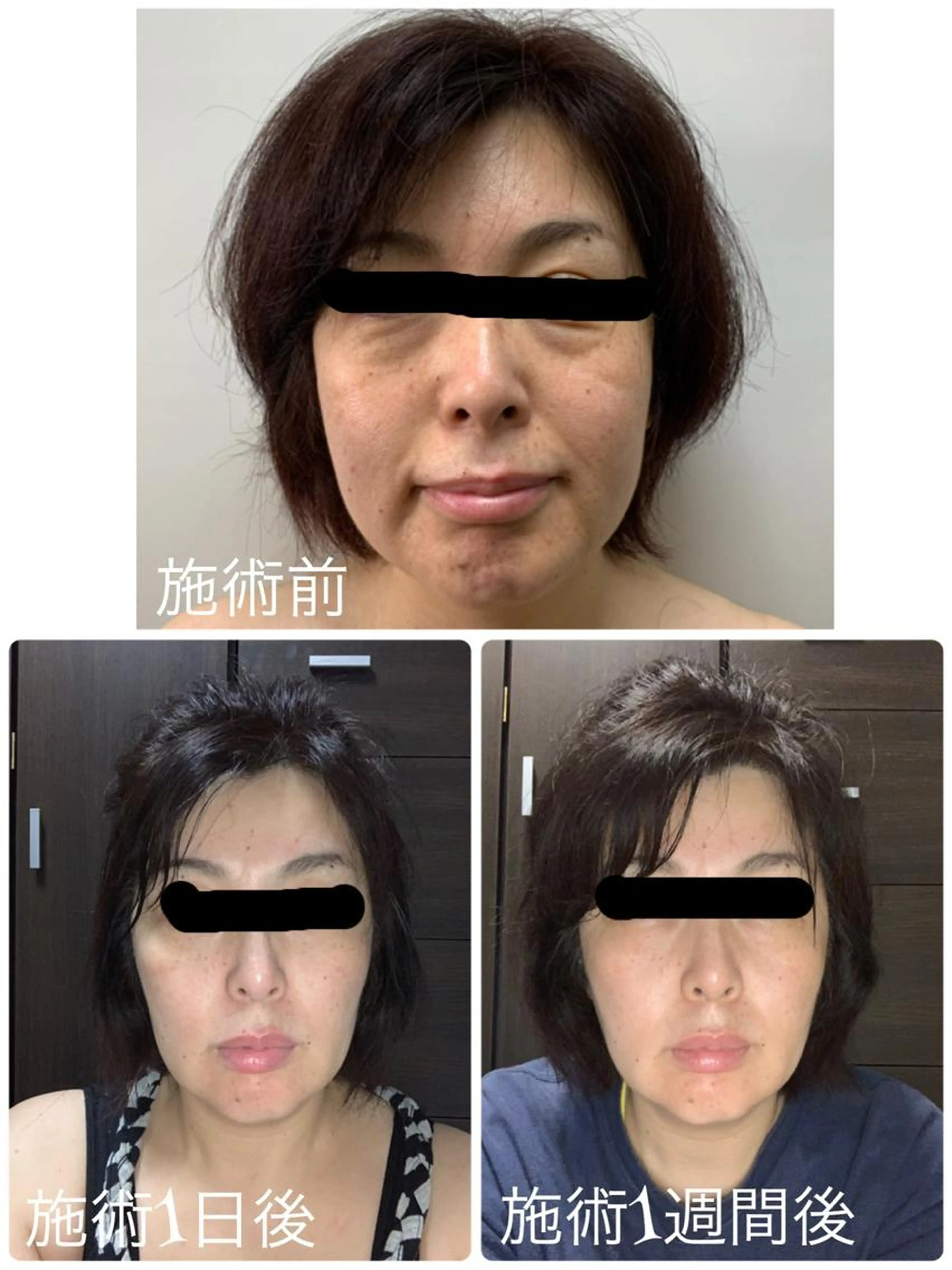 小顔痩身【お試し価格】 １回利用可の写真