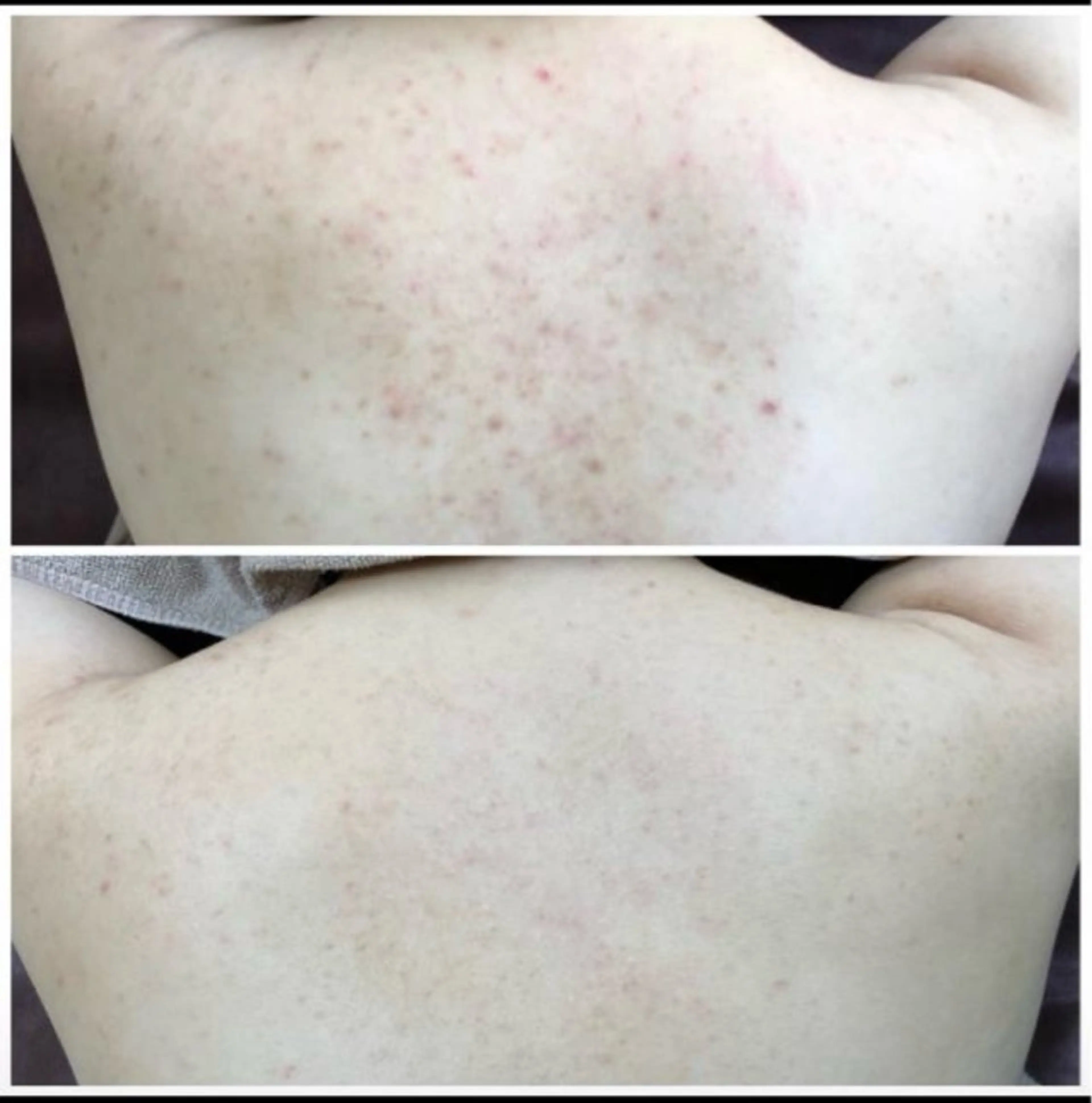 🌿背中ハーブピーリング✨【剥離あり】【毛穴洗浄】【GF美容液】ニキビ/ニキビ跡/黒ずみ/水光肌/毛穴ケア/ゴワ/毛孔性の写真