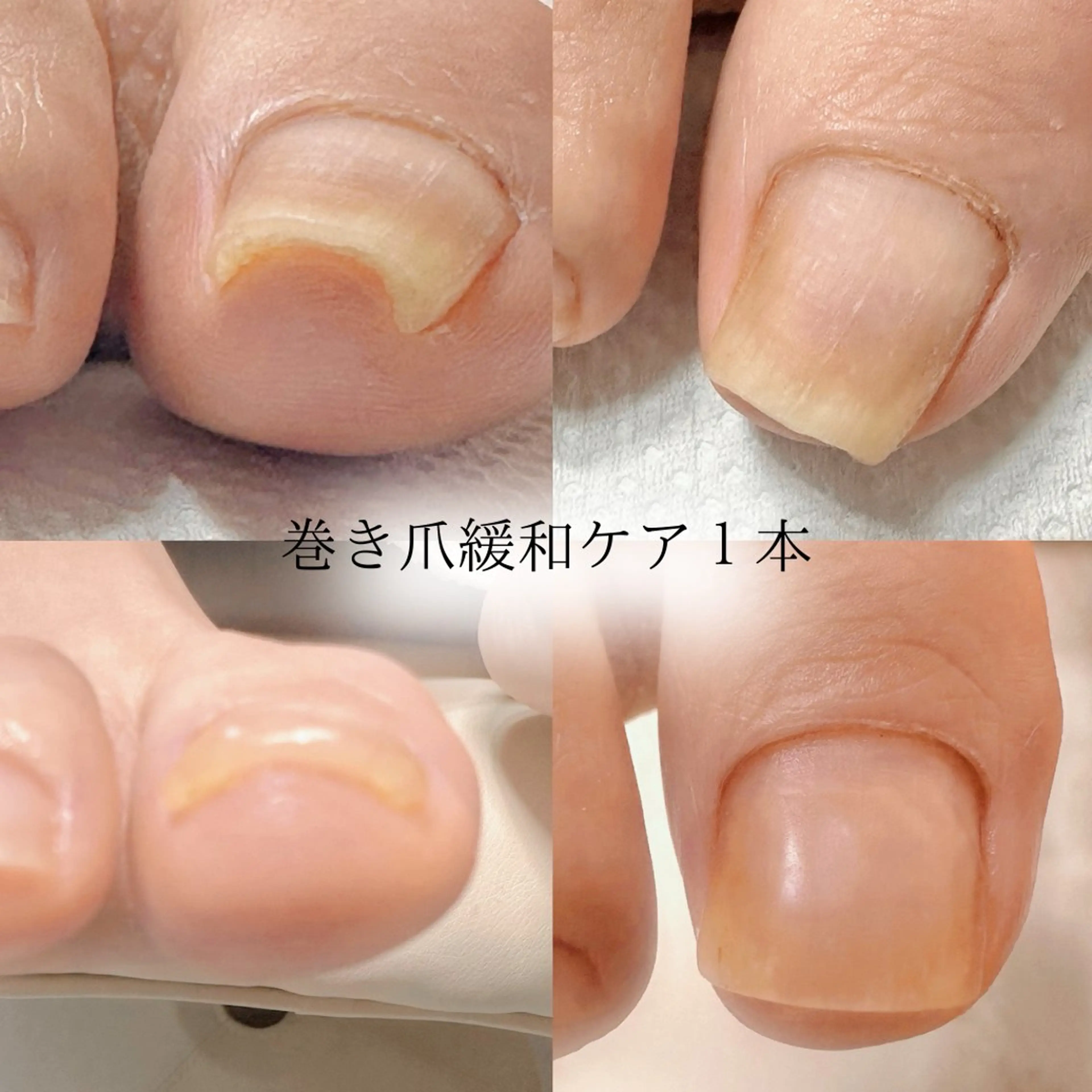 巻き爪緩和ケア＜1本＞🎁ご新規様ホームケアセットプレゼント🎁の写真