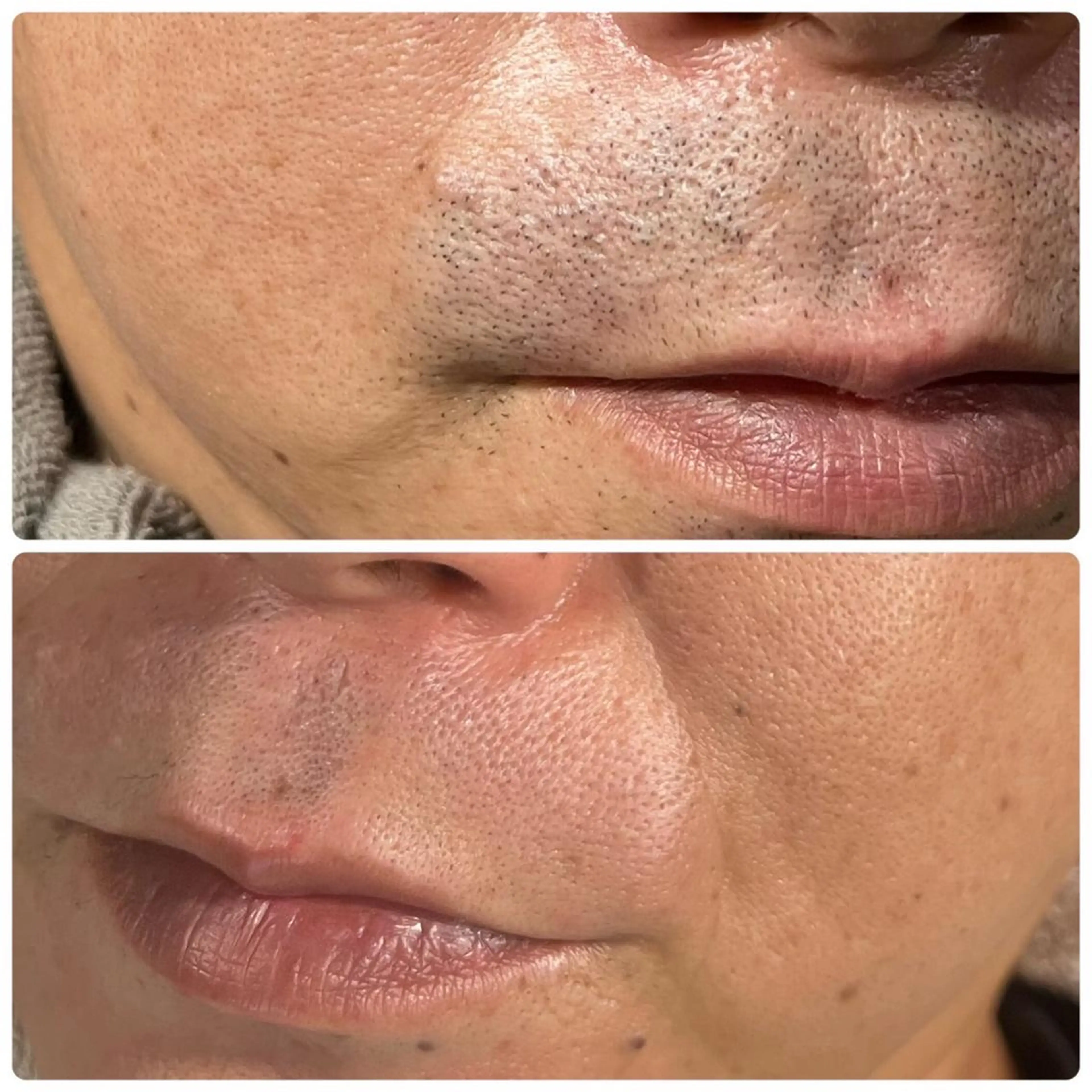 【メンズ】顔脱毛【ひげ】の写真