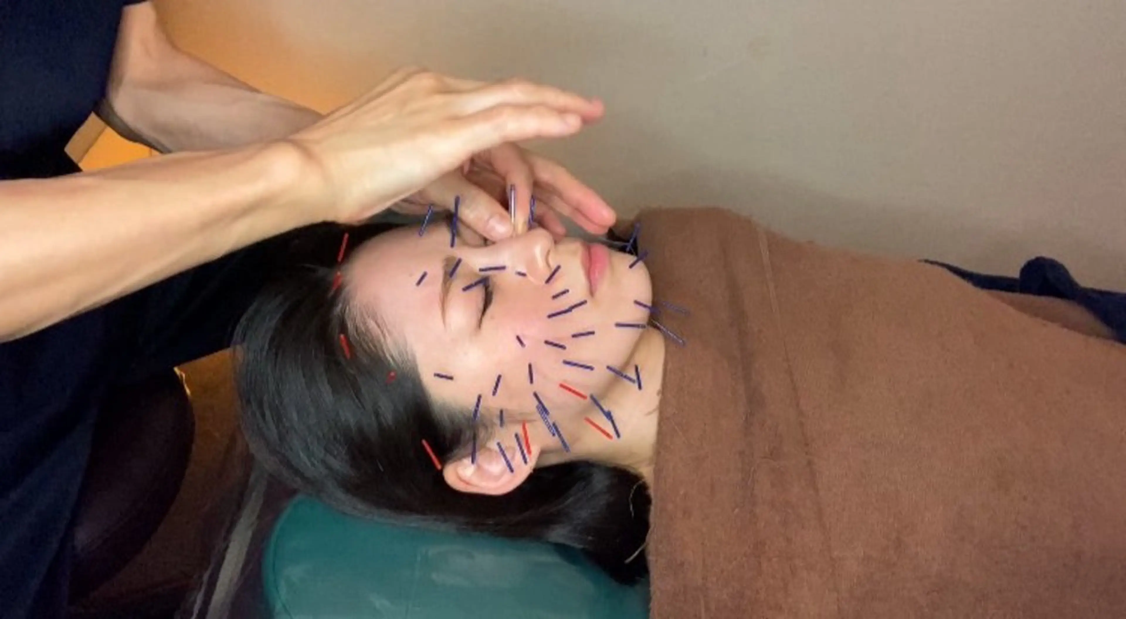 【ミニモ限定割】美容鍼➕たっぷり60分全身リラクゼーションマッサージ(骨盤調整☆猫背調整付き！)美容と疲労回復を同時に♪の写真