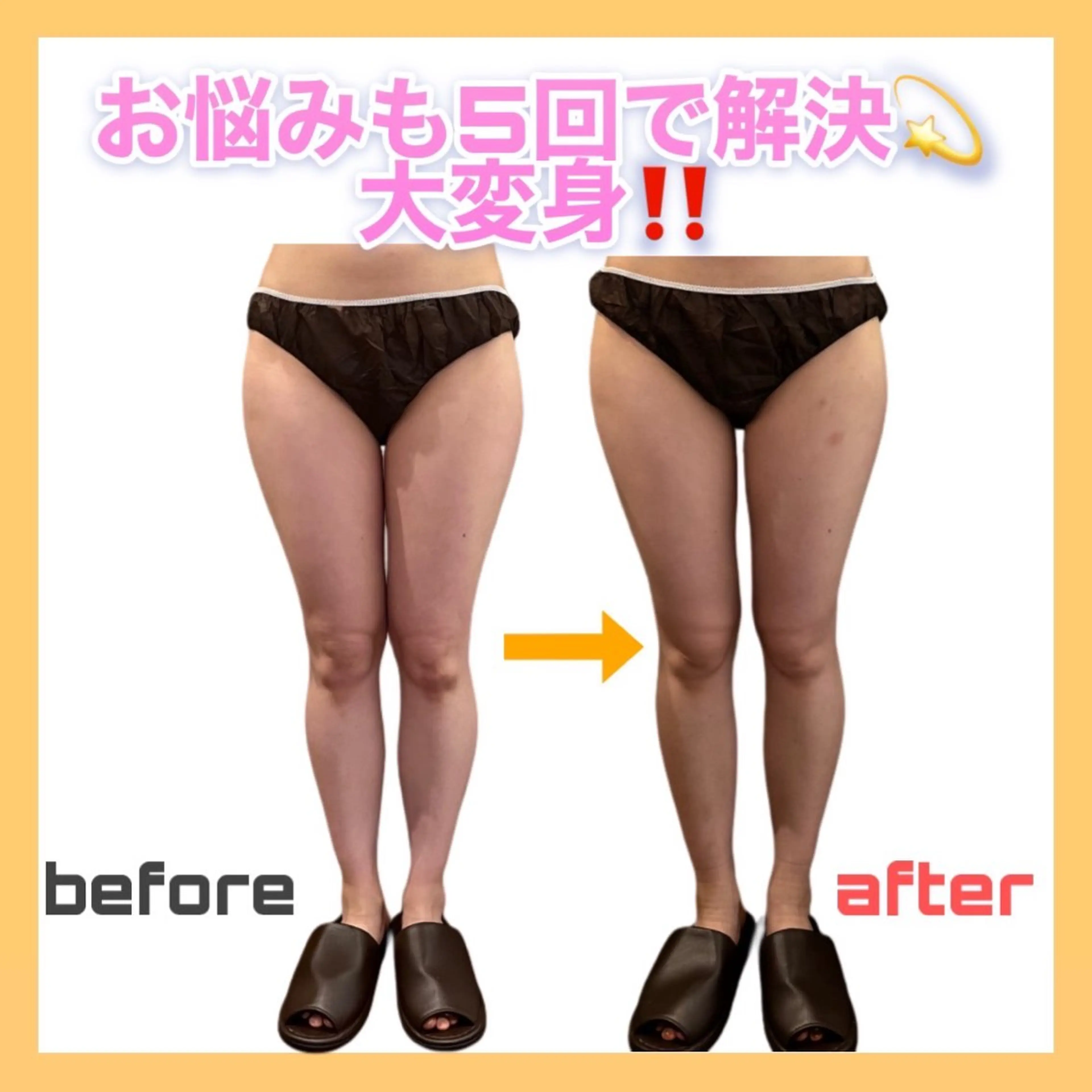 【夏までに美脚作り👙🏝️】業界最高峰のラジオ波✖️セルライト吸引機器✖️リンパマッサージで集中的にアプローチ🔥の写真