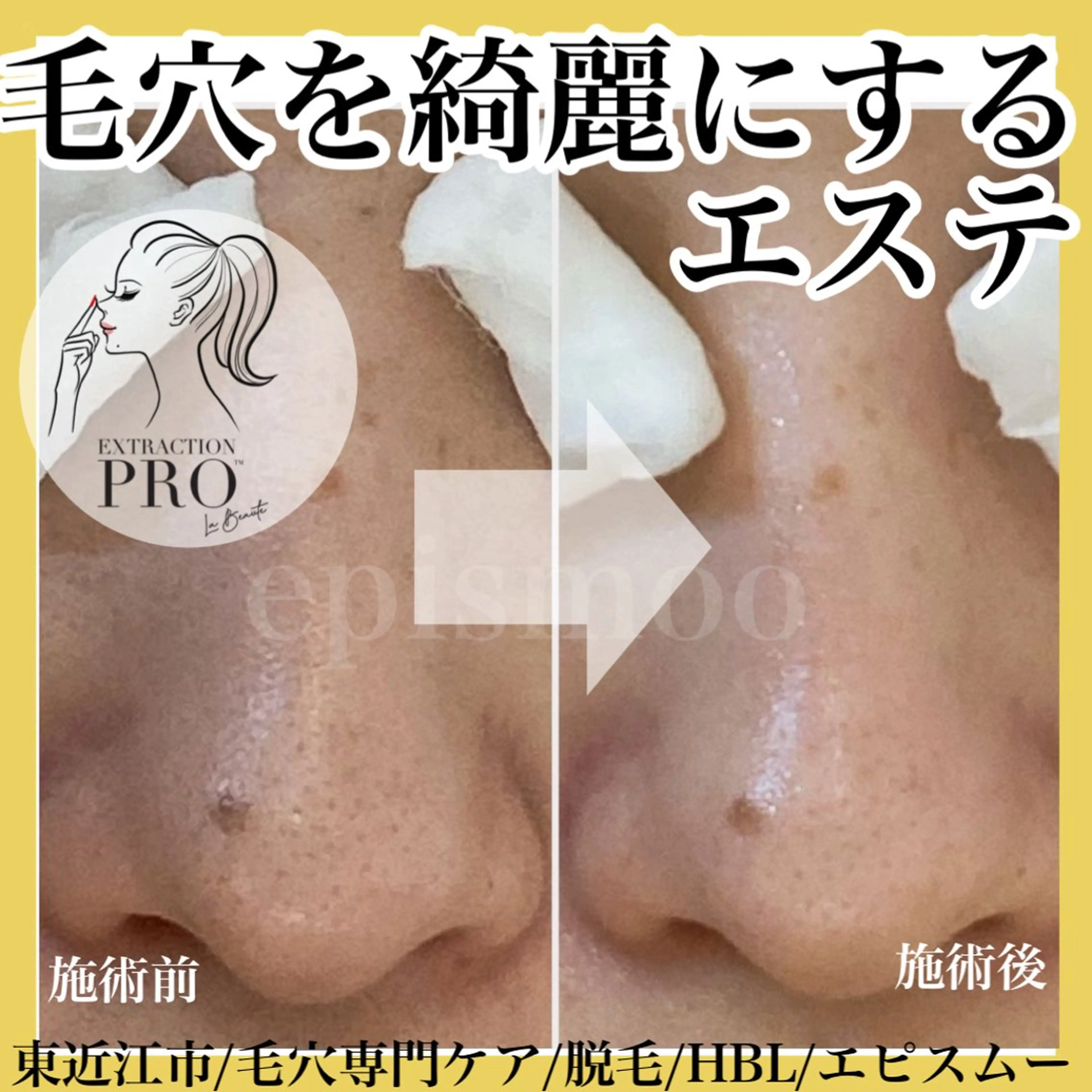 epismoo 脱毛/HBL/毛穴の眉毛・アイブロウイメージ