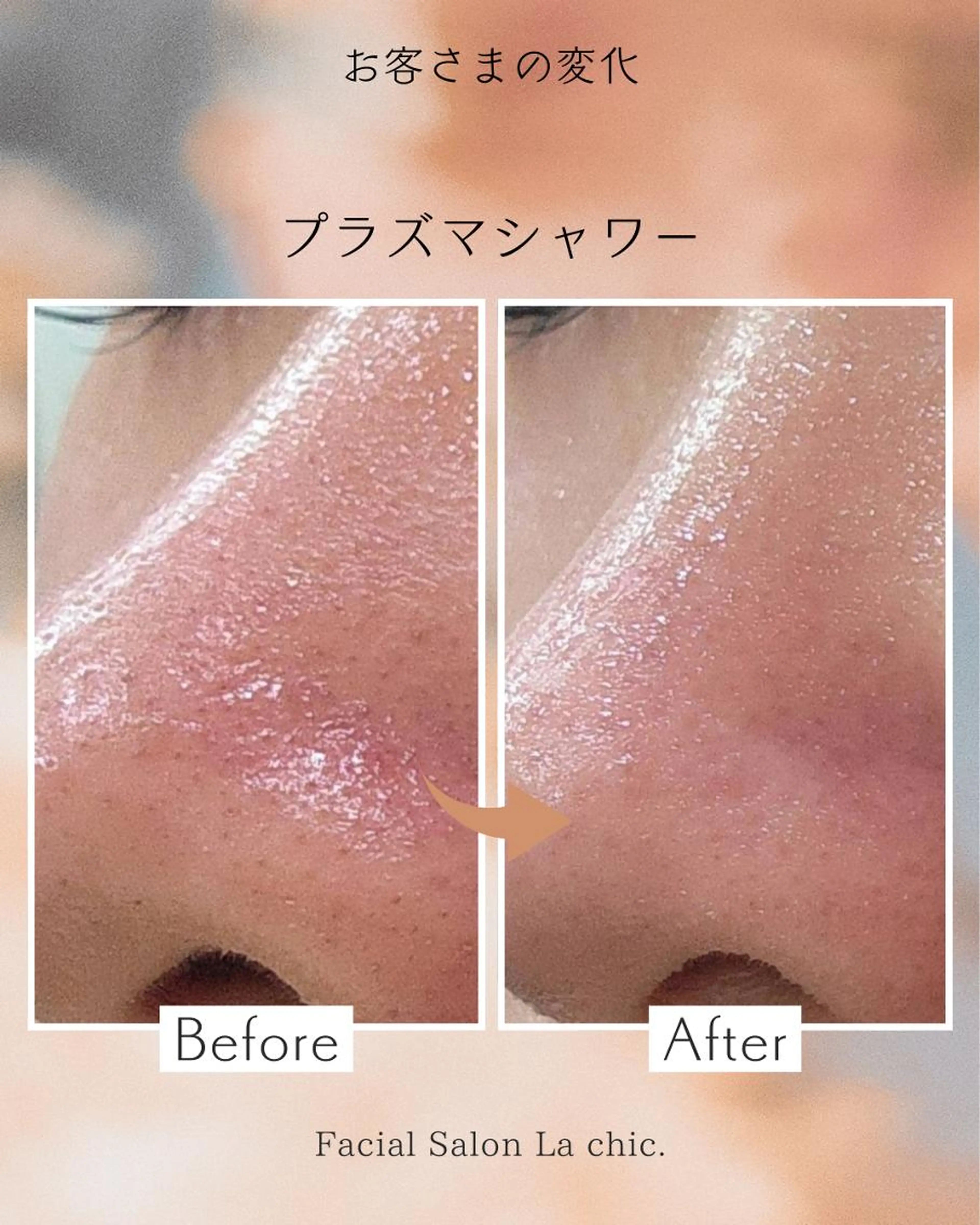 【ニキビ・シミ・シワ・毛穴の開き・ほうれい線に】毛穴洗浄×プラズマシャワー💖の写真