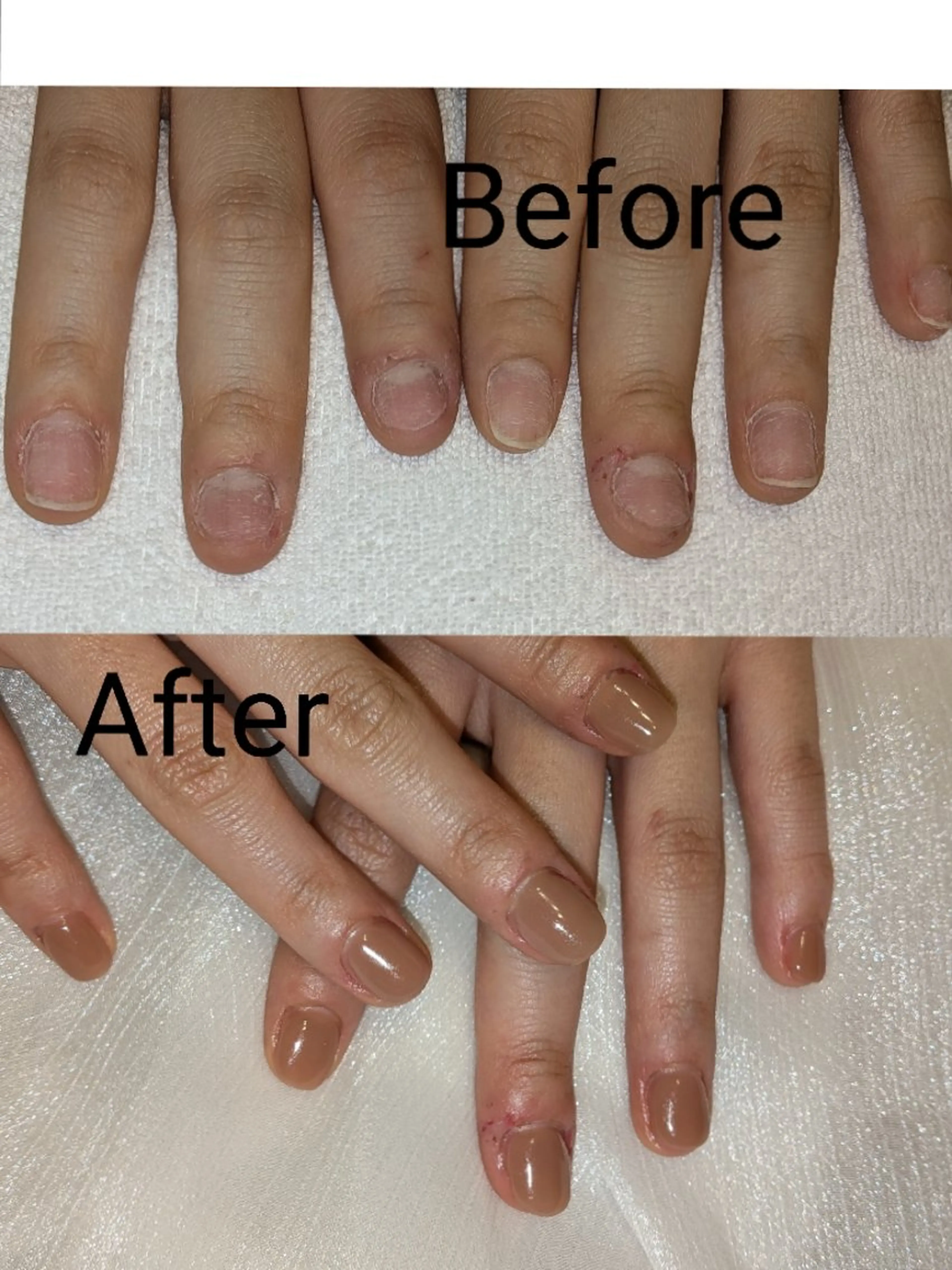 ネイル ハンドネイル ハンドケア フィルイン、長さ出し 深爪矯正のネイルデザイン