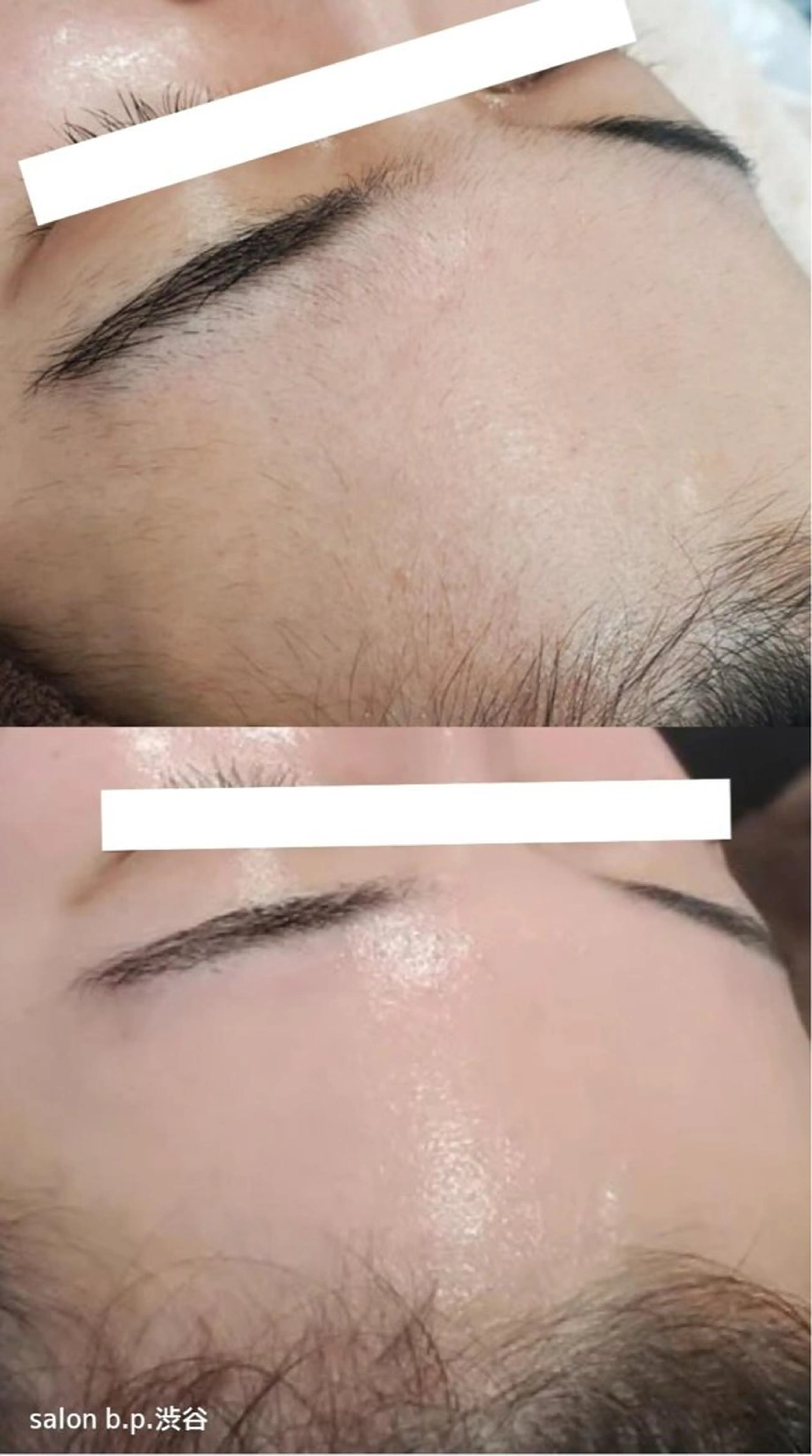 No.1人気！産毛や角質をつるんとフェイシャルワックス脱毛🥚✨&剥離なしハーブピーリング🌿の写真