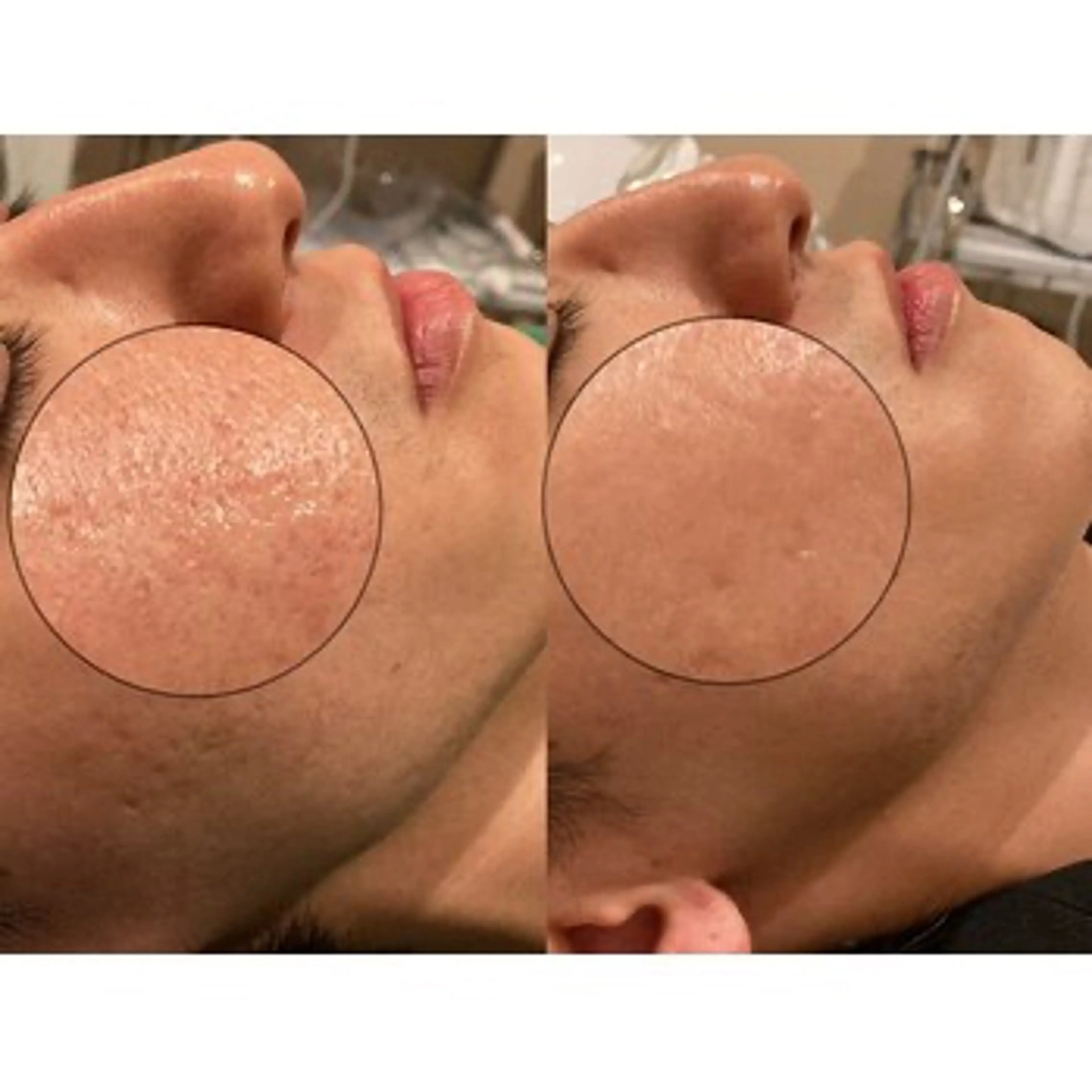 【ニキビ跡・クレーターケア】頬のみサーマトリックス照射＋鎮静パック付き！の写真