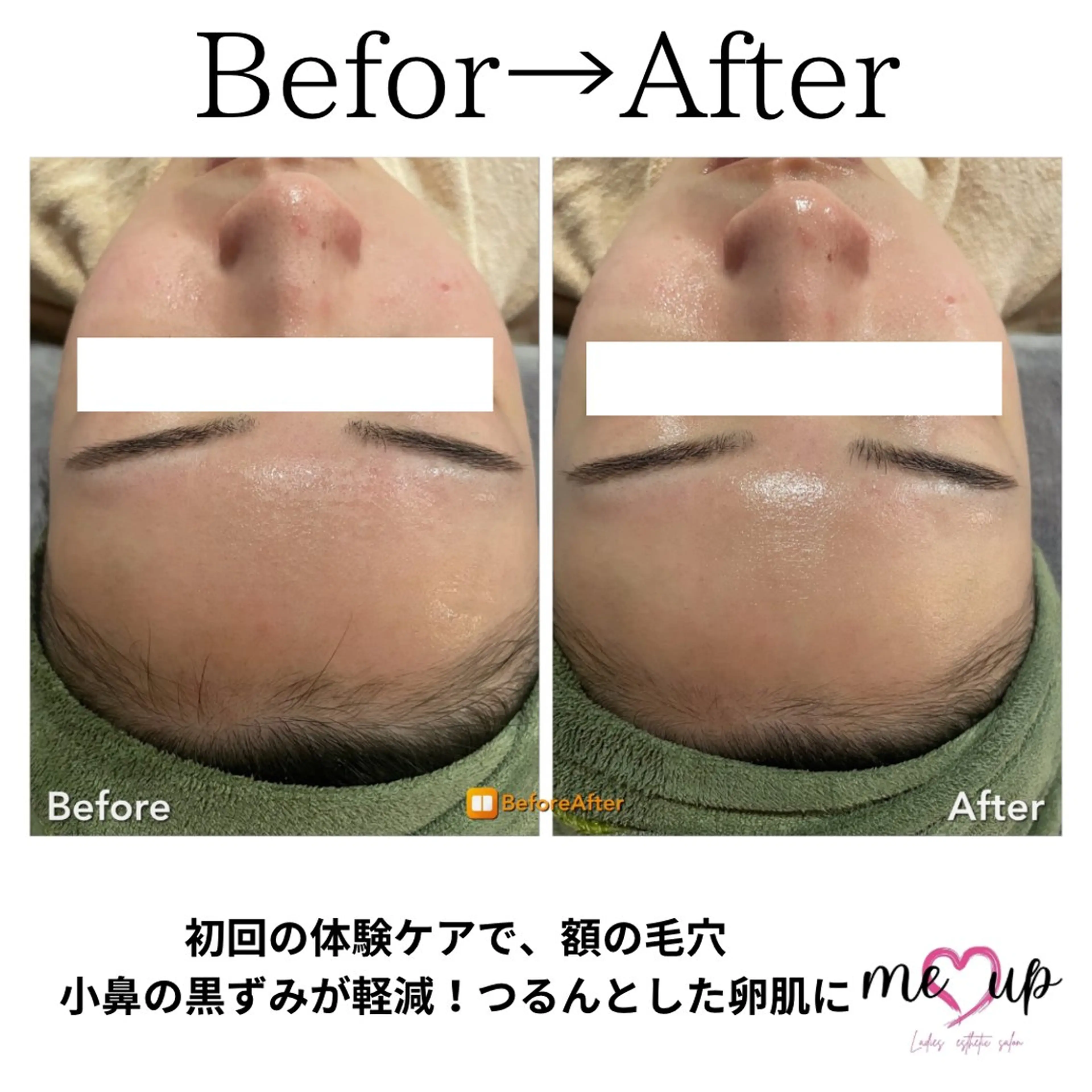 Meupニキビ専門店 背中/ハーブ/肌管理のその他イメージ