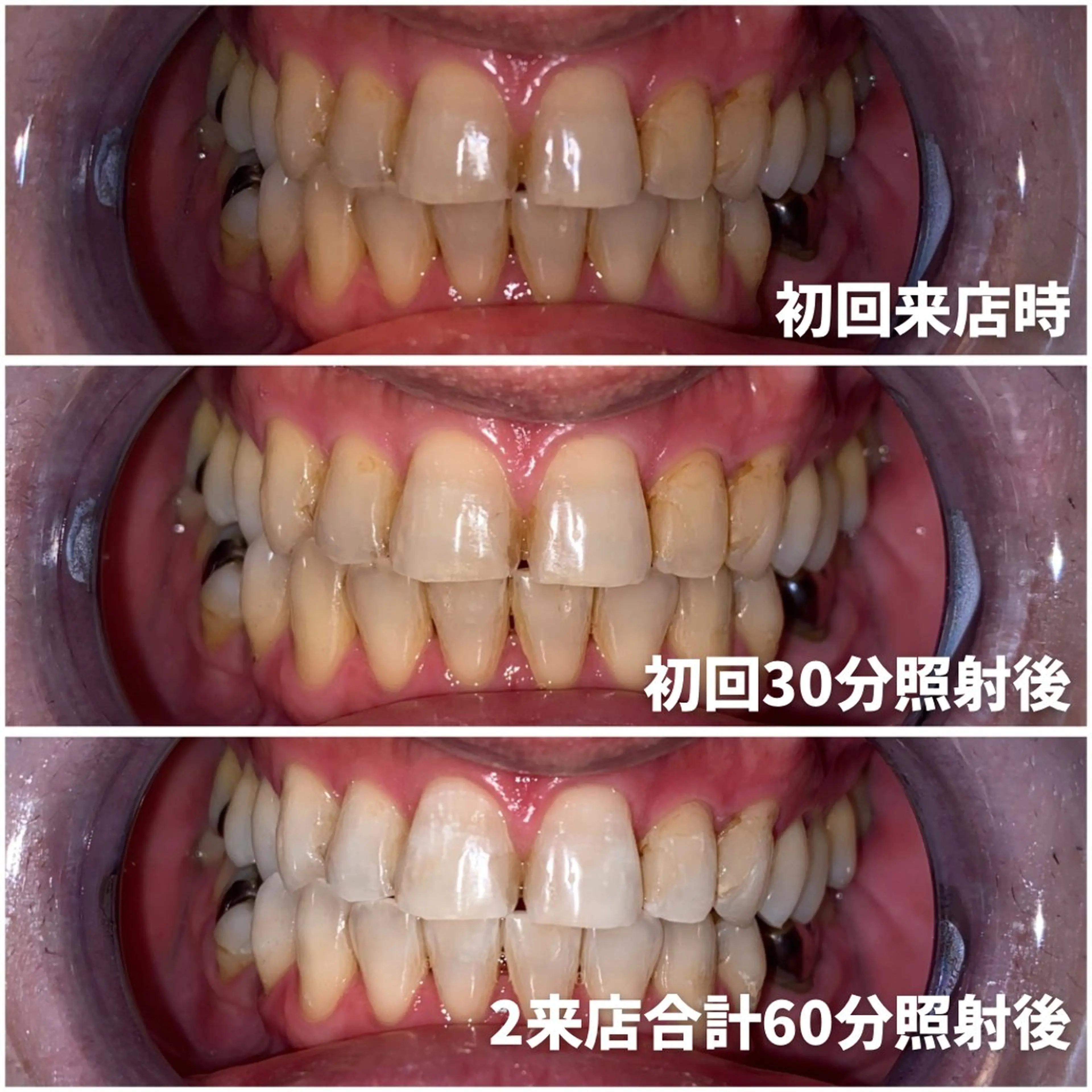 【成人式プラン】2来店合計60分照射コースの写真