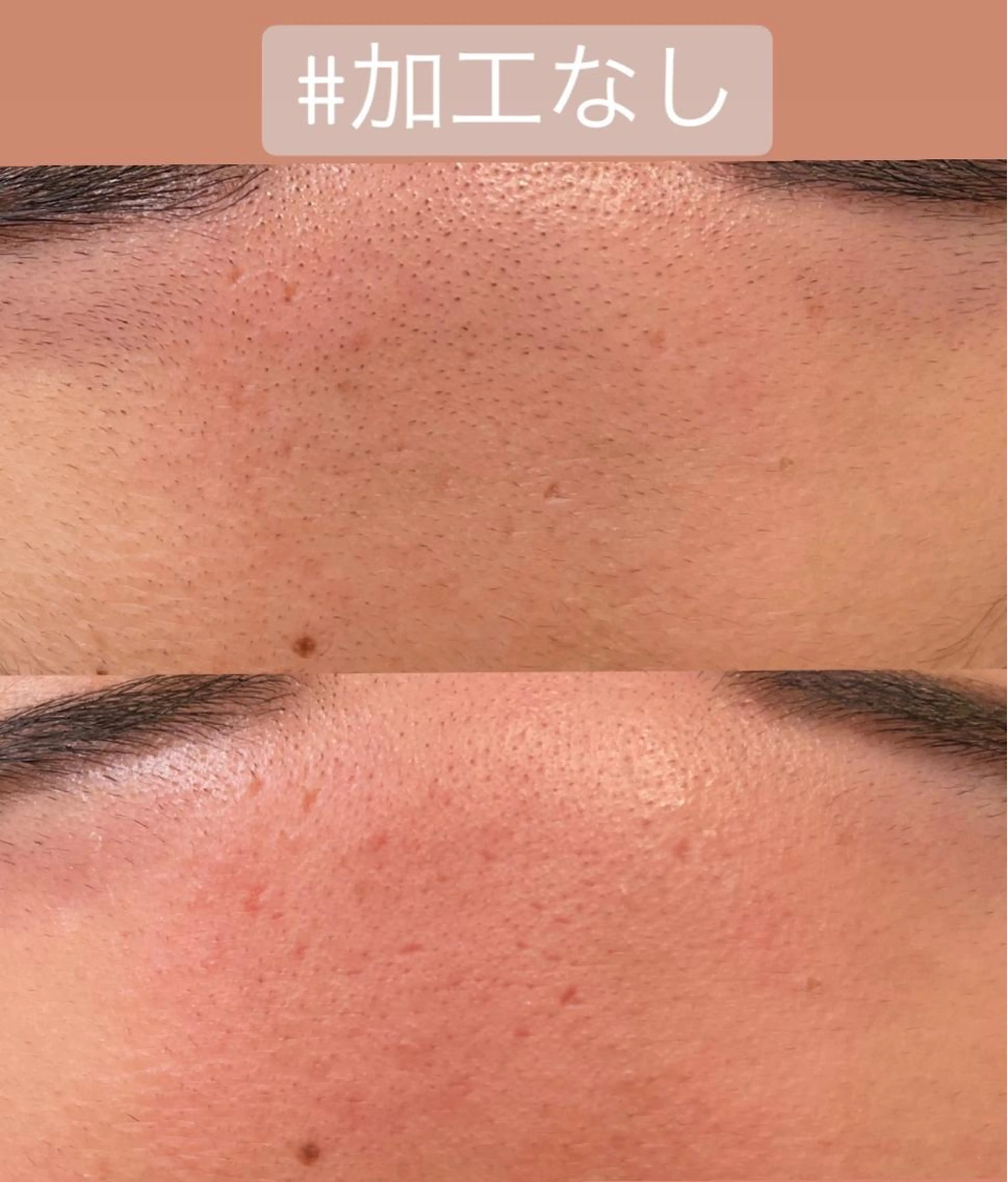 おでこのワックス脱毛の写真