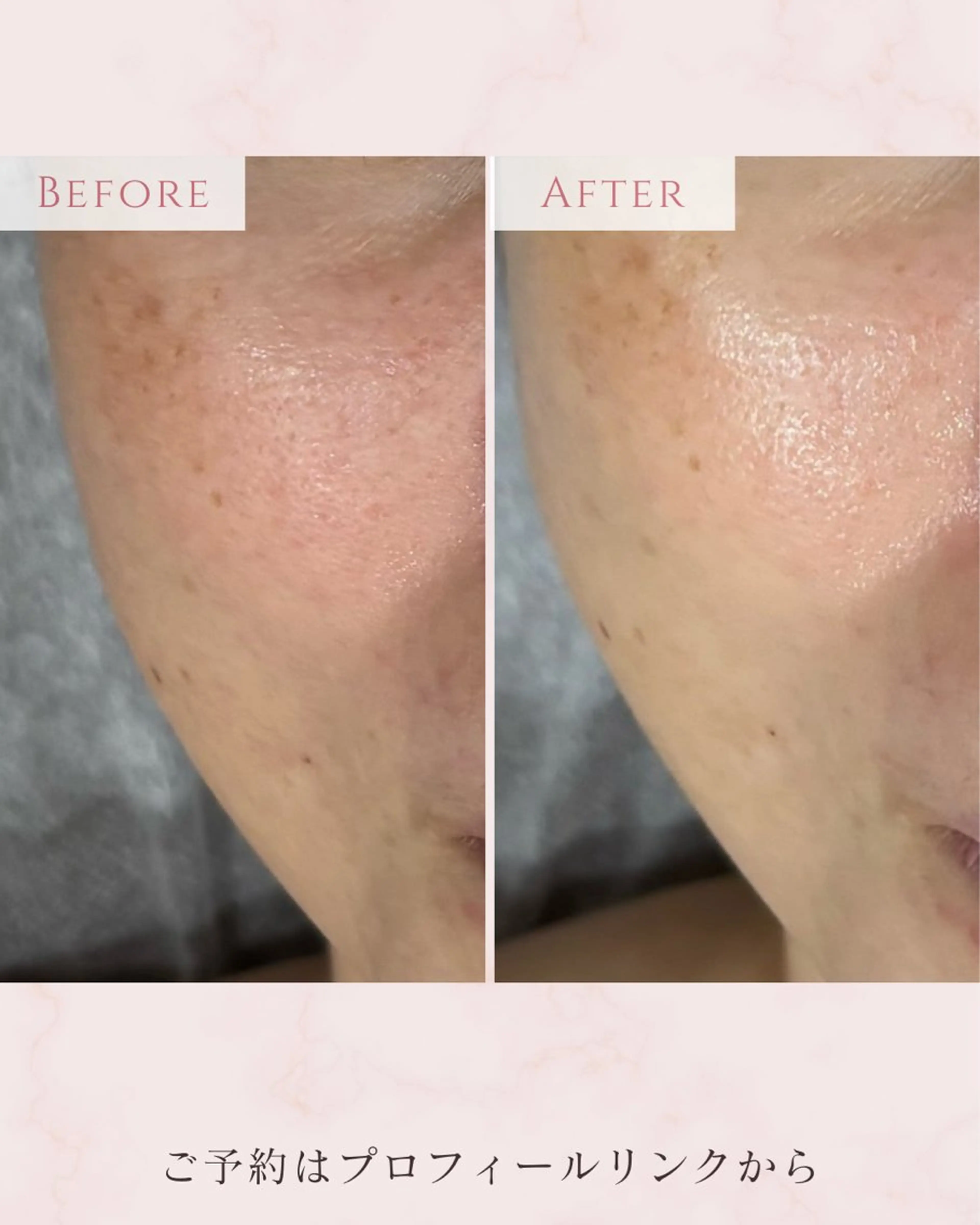 ✨毛穴・黒ずみ・くすみケアフェイシャルの写真