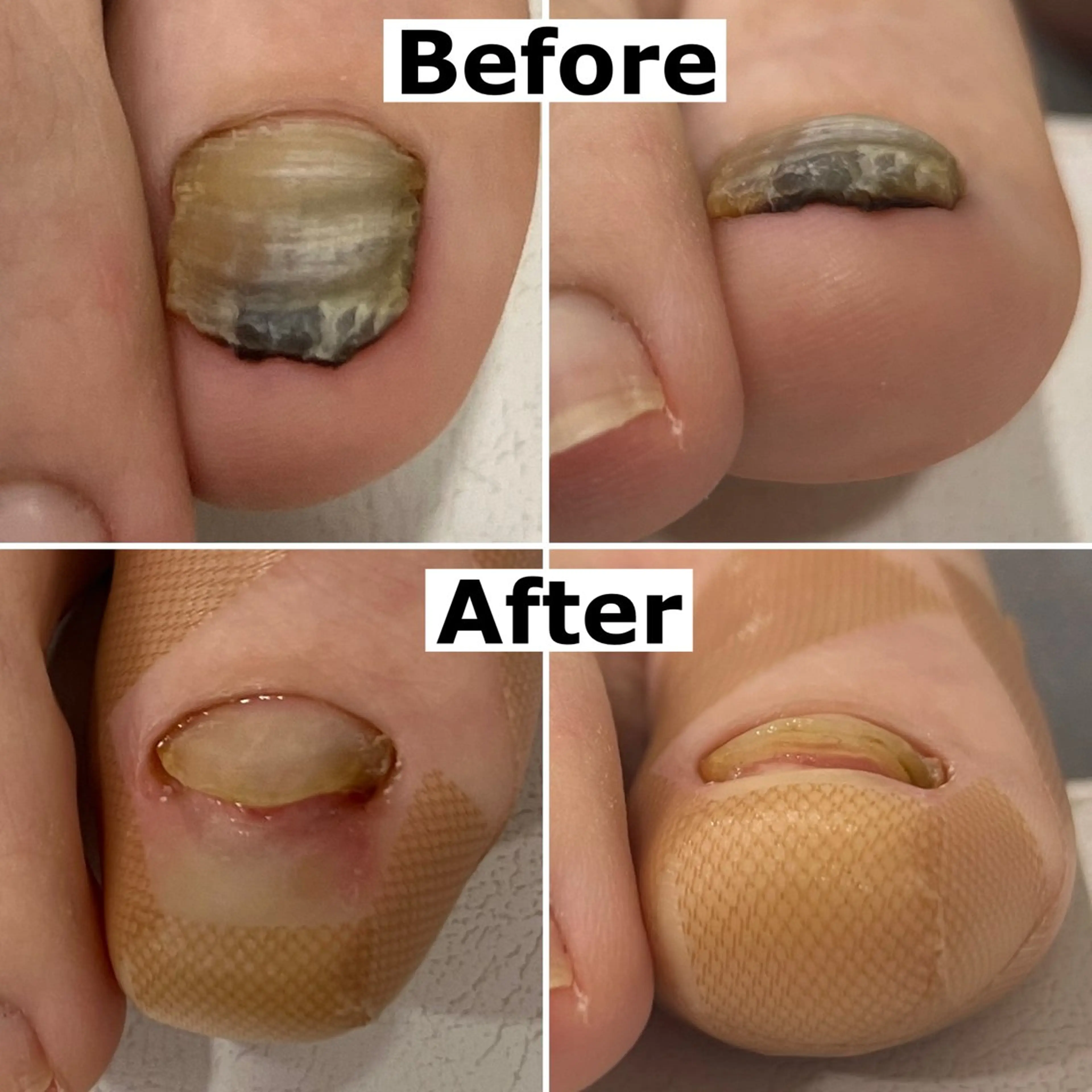 ネイル Mellow nail所属・巻爪無料モデル募集 ✨🦶MEGUMIのネイルデザイン