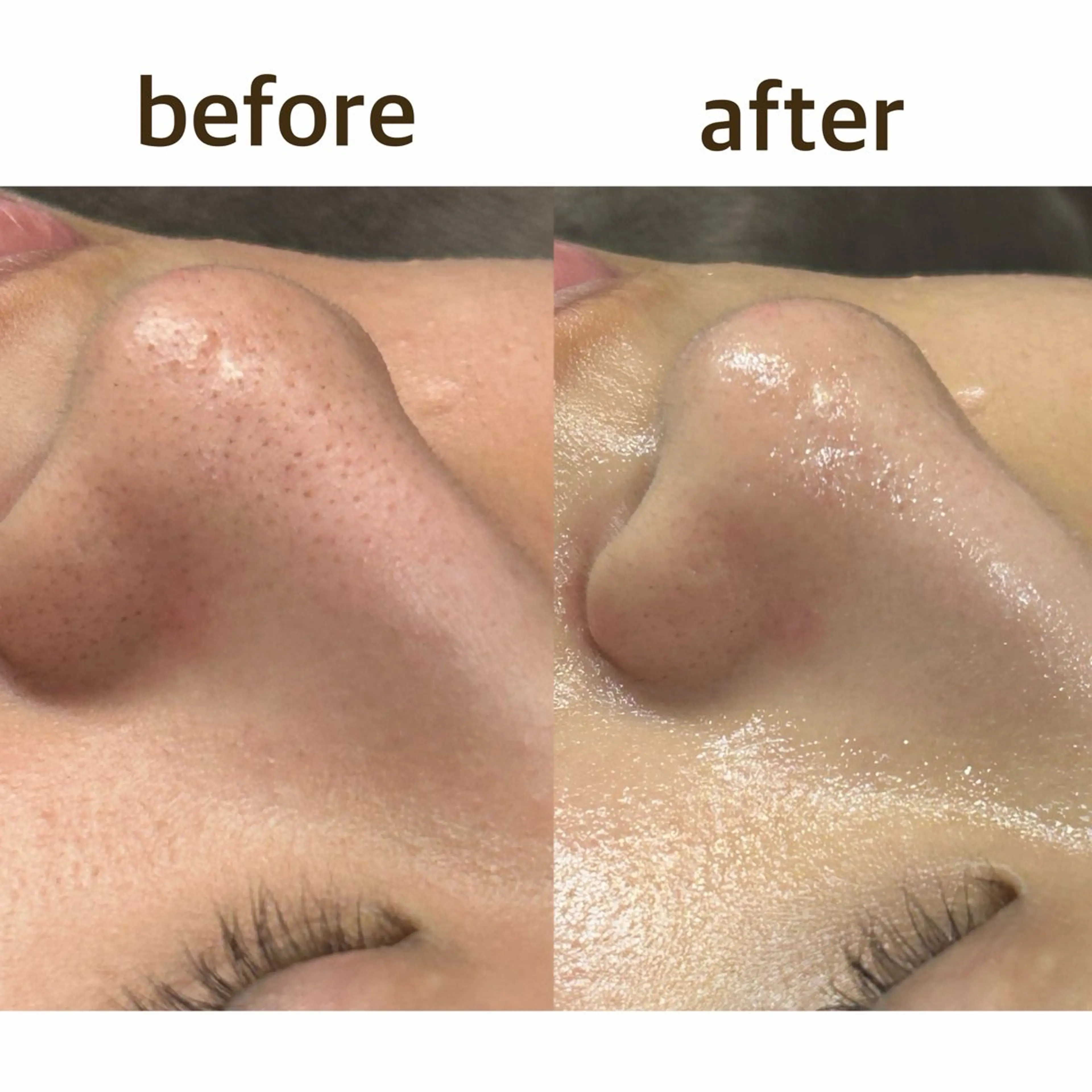 《人気No.1》徹底毛穴ケア60分の写真