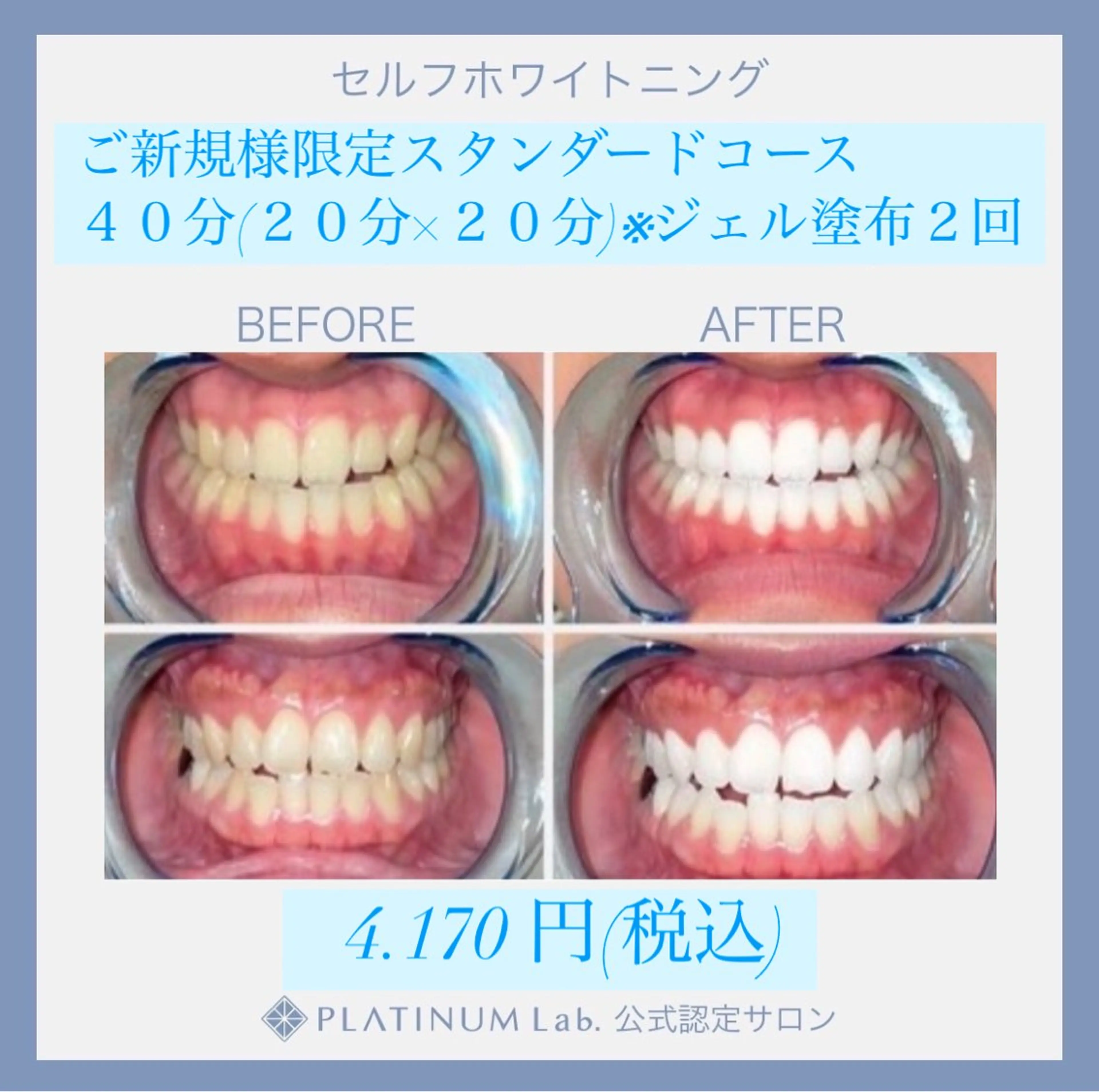 ご新規様限定🦷スタンダードコース40分(20分×2)✨メンズも大歓迎✨！☝️の写真