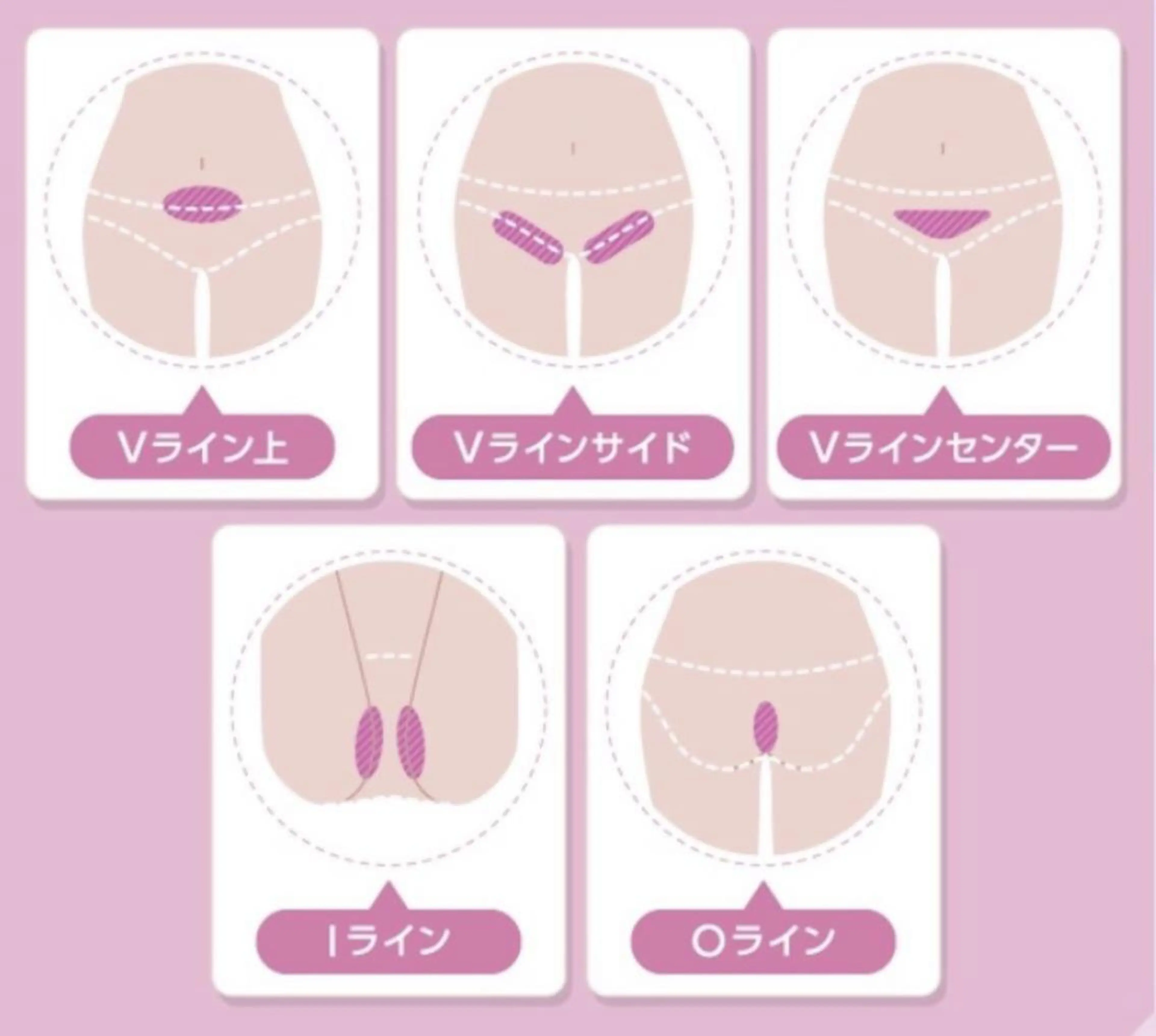 脱毛 【天神・大名】脱毛/ ハーブ植松७९०のその他イメージ