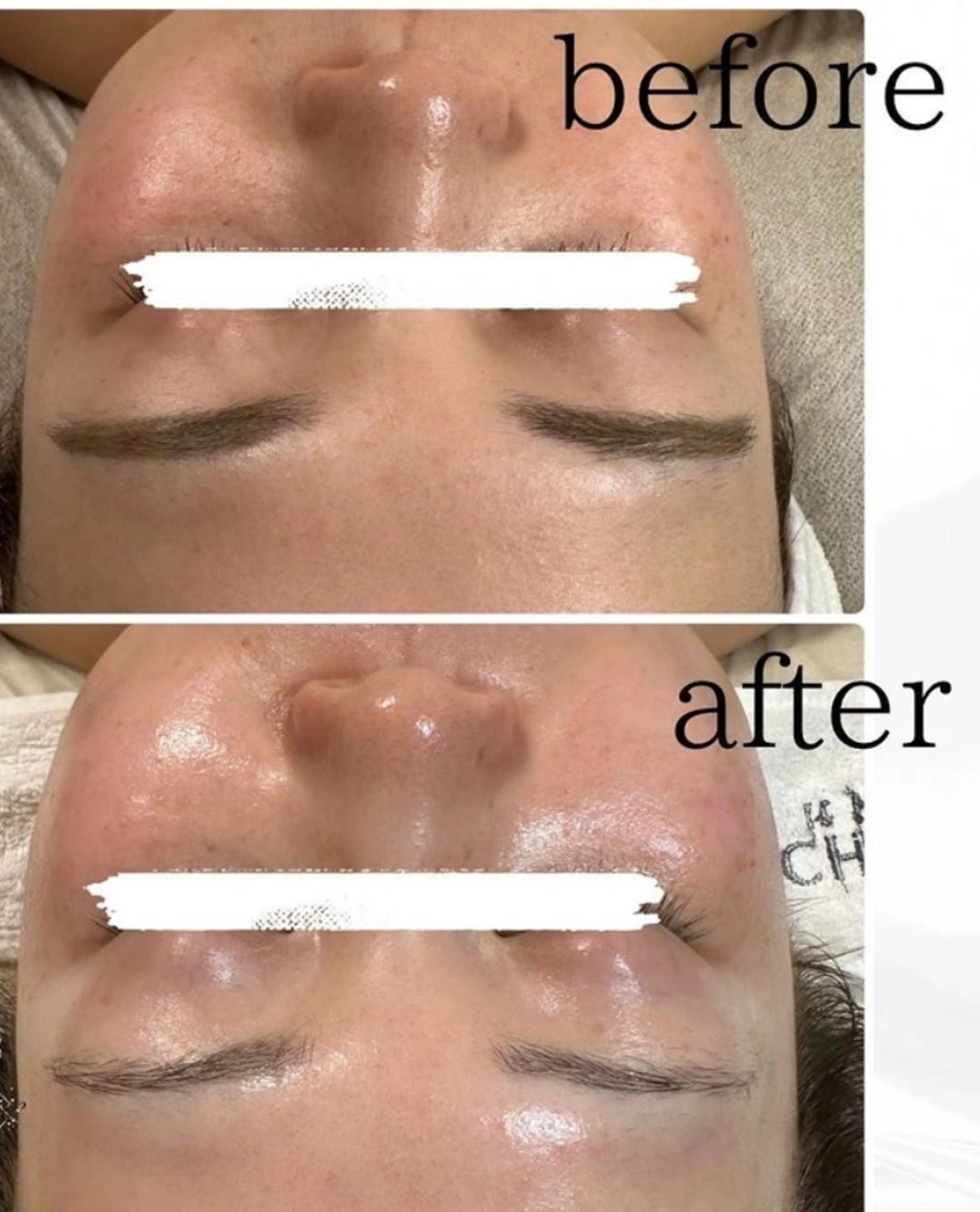 エステ エイジングケアサロンBIOEL所属・肌質改善BIOELプ ラズマ/ラミピールのエステ・リラクイメージ