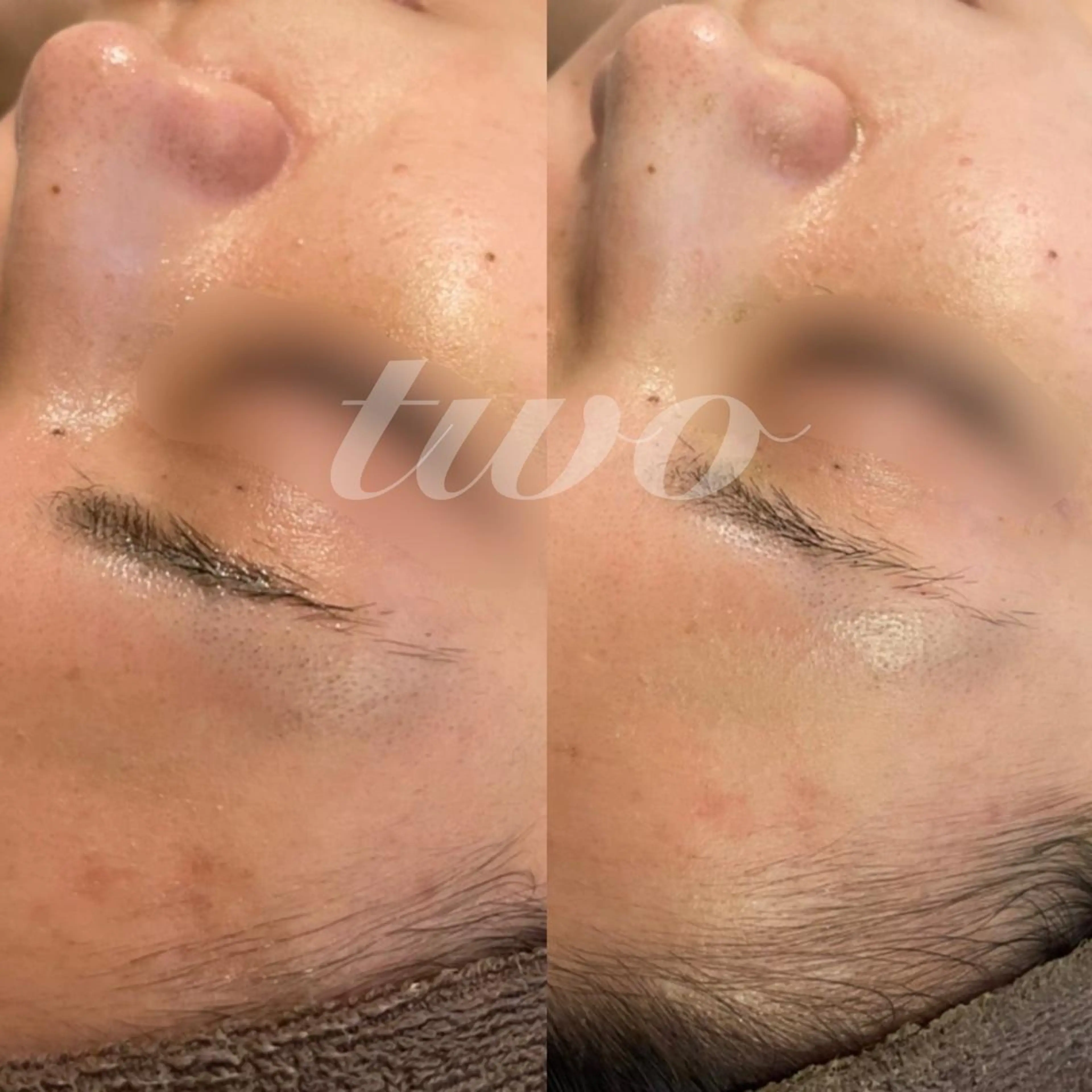 ハーブピーリング（顔+首）フェイシャルマッサージ有りの写真