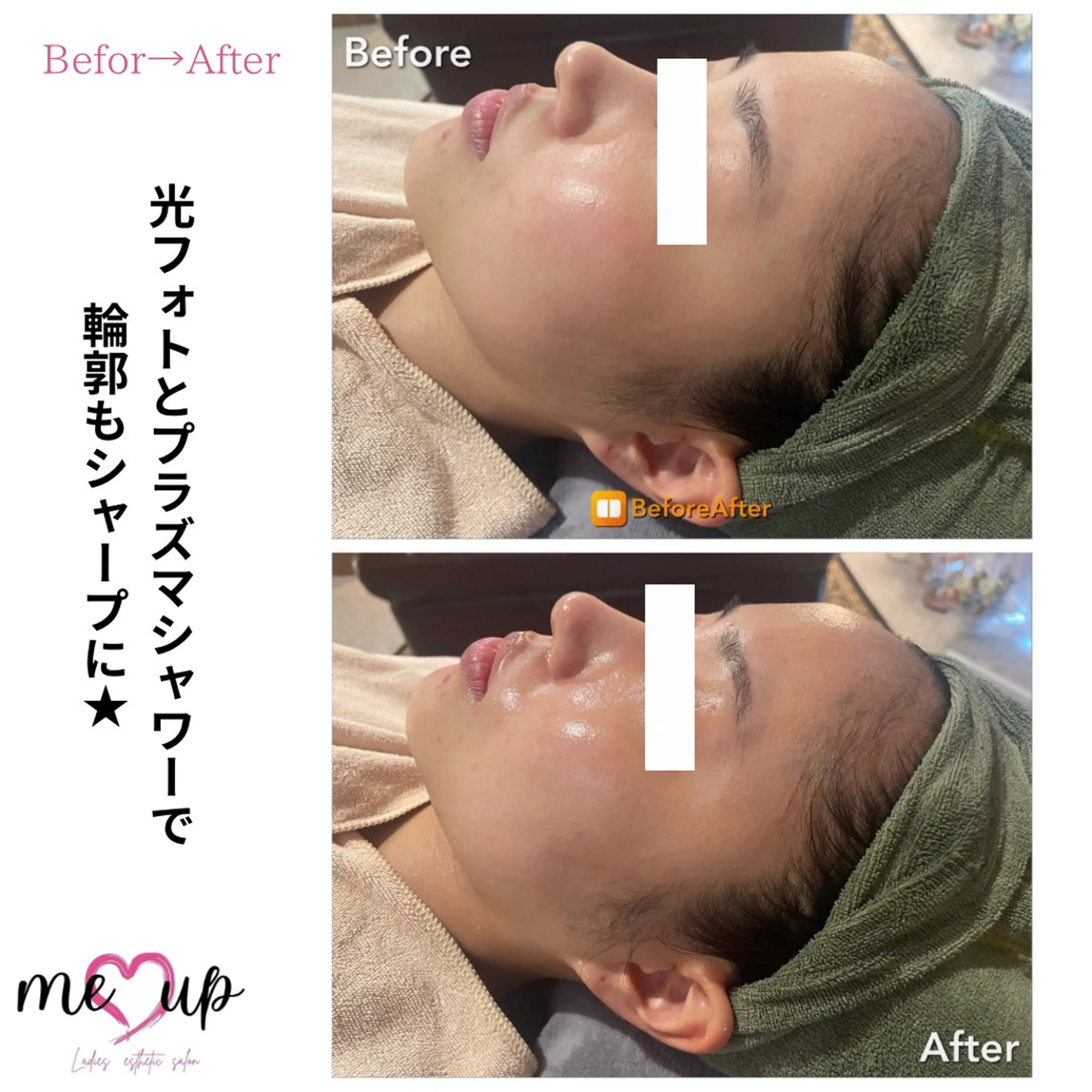 Meupニキビ専門店 背中/ハーブ/肌管理のその他イメージ