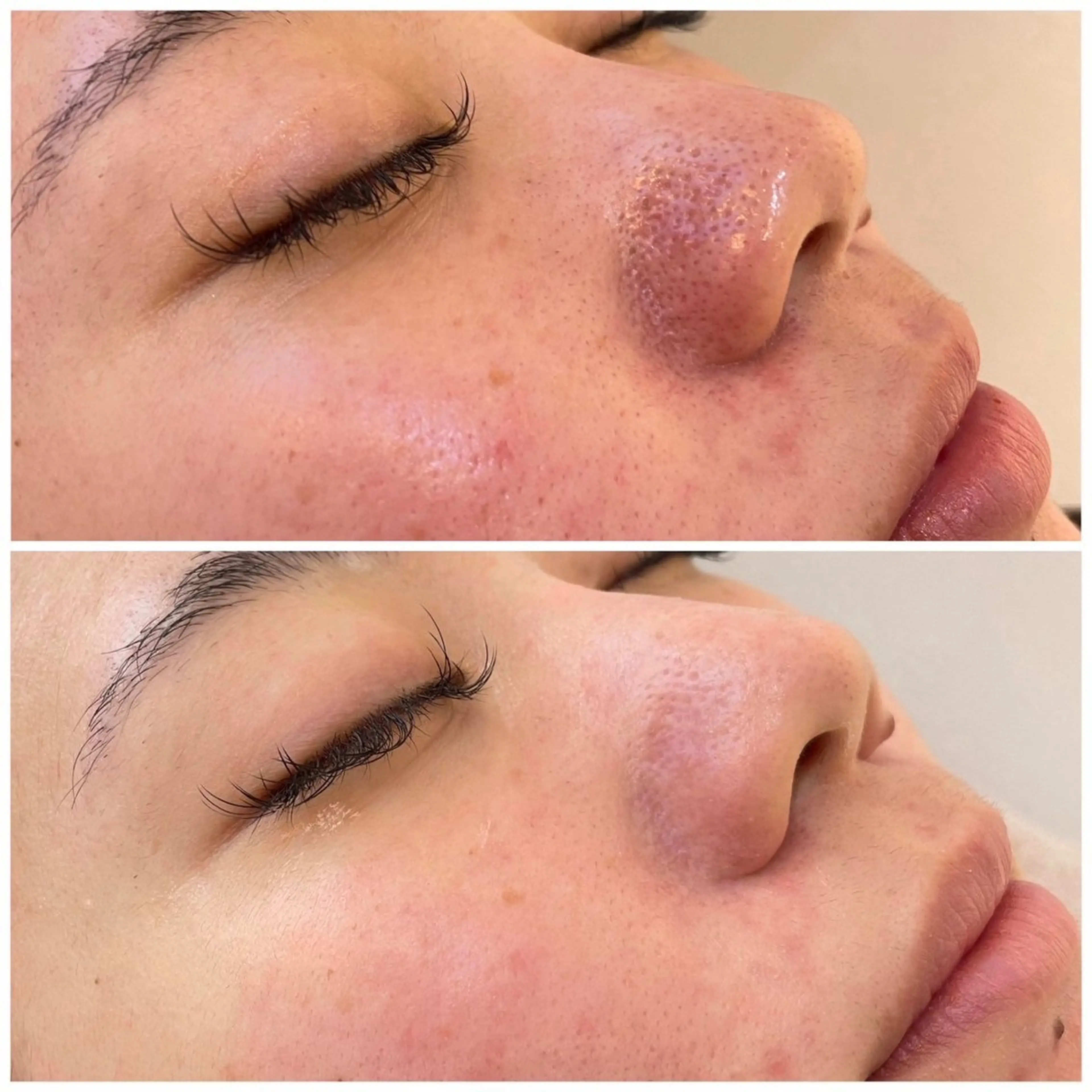 お悩み「毛穴」撃退コースの写真