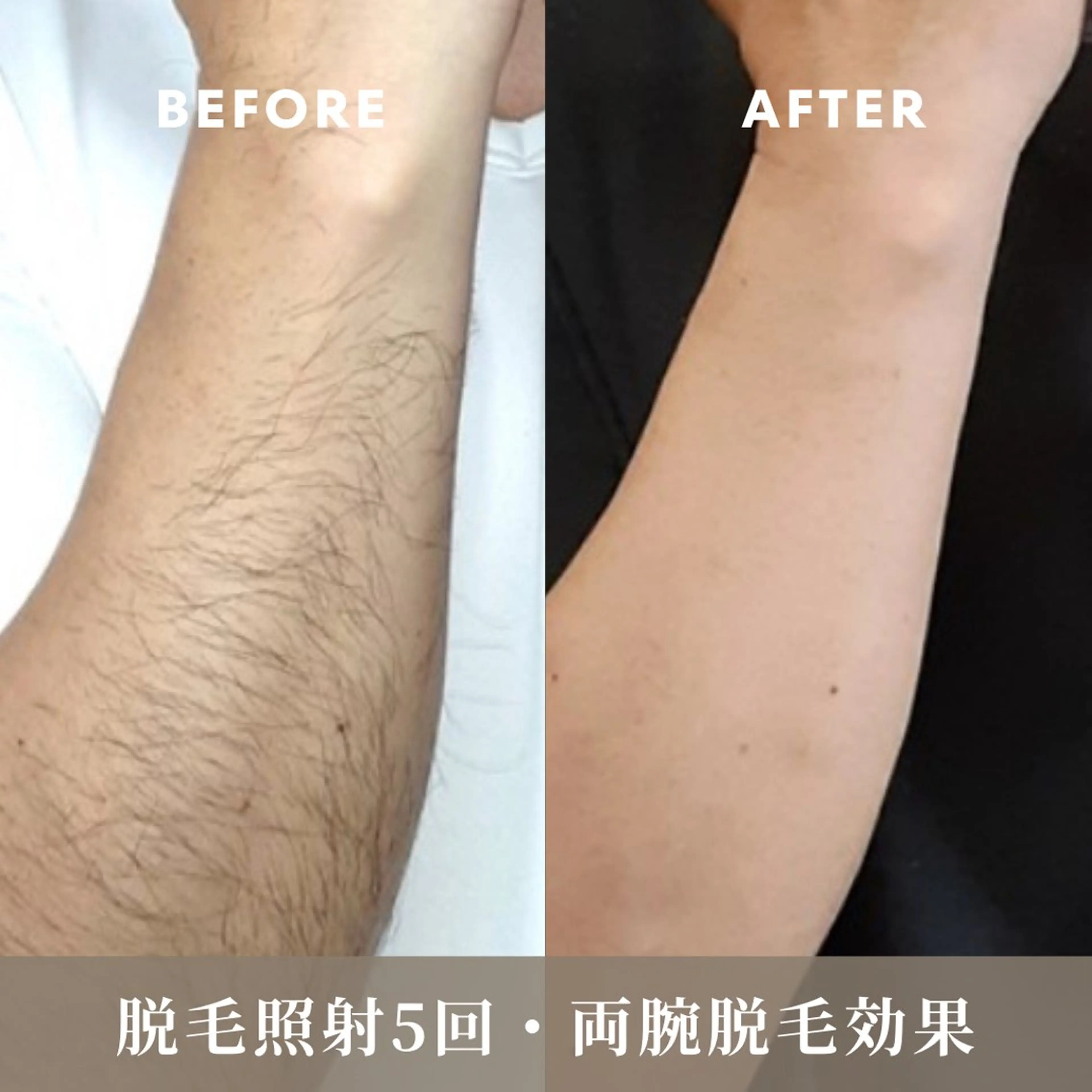 全身脱毛【顔・VIO込み】保湿成分配合ジェル使用の写真