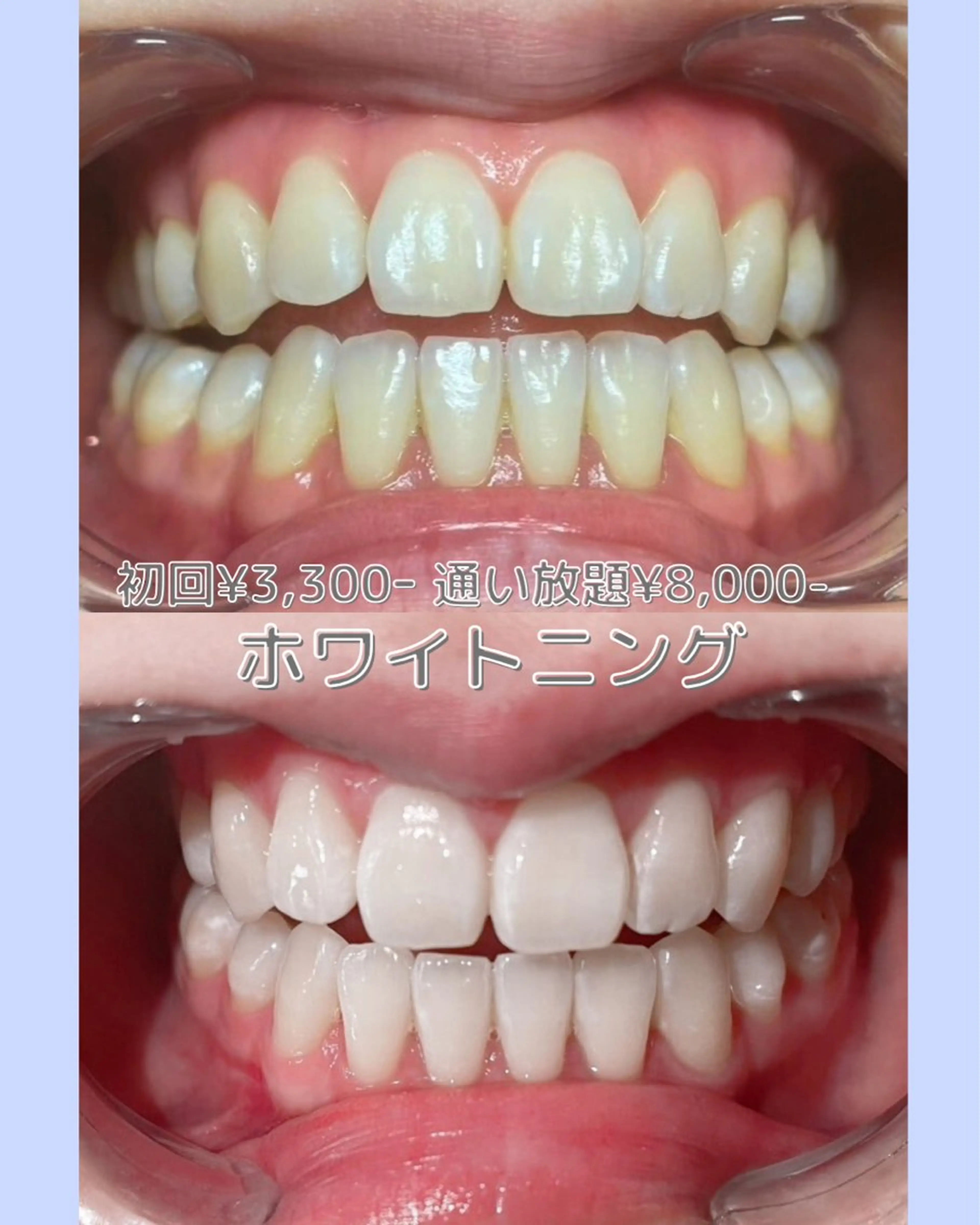 ✨🦷ホワイトニング初回🦷✨⏰60分の写真