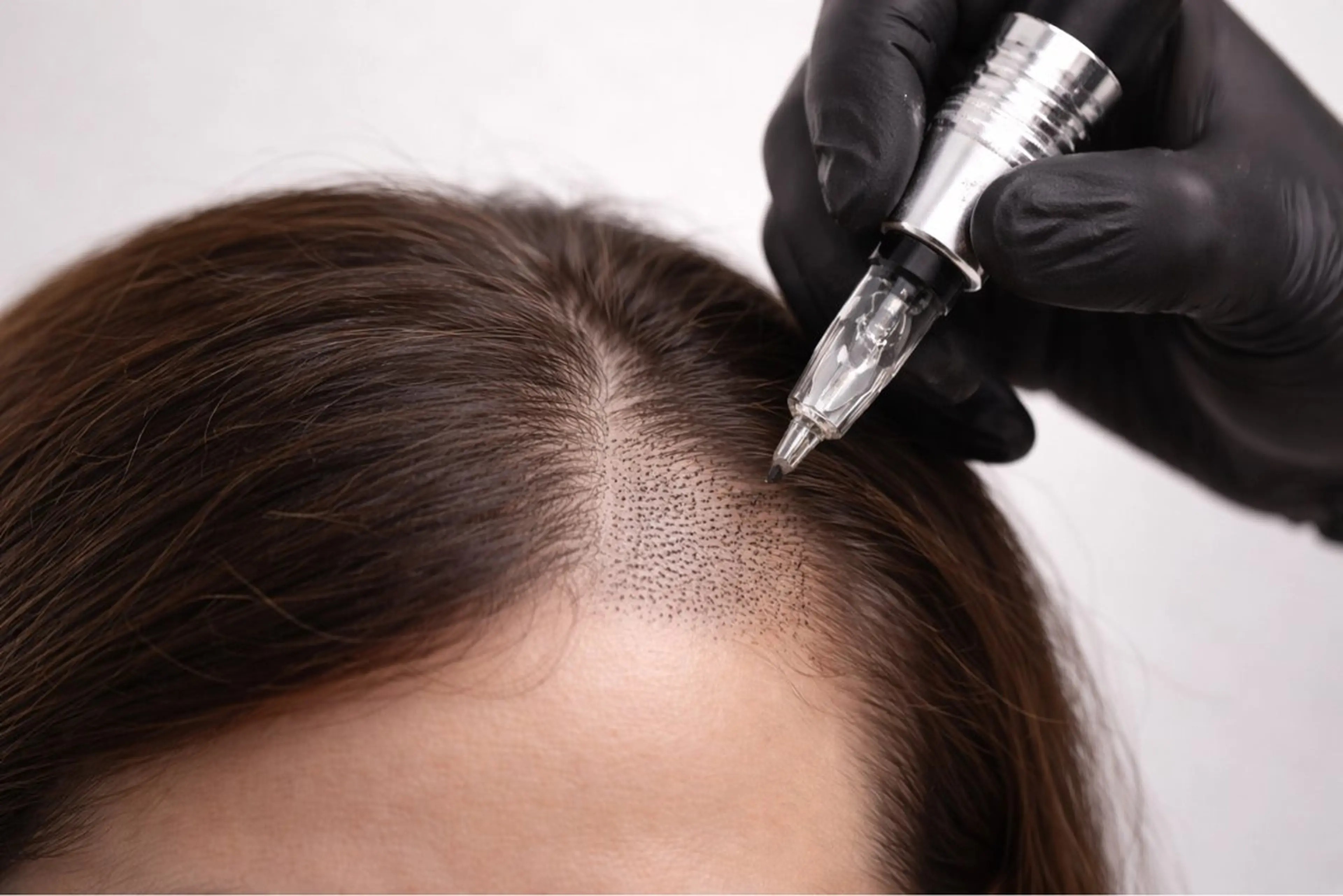 【頭皮密度デザイン】生え際・頭頂部の透け感を２週間で改善🔥「カウンセリング専用」の写真