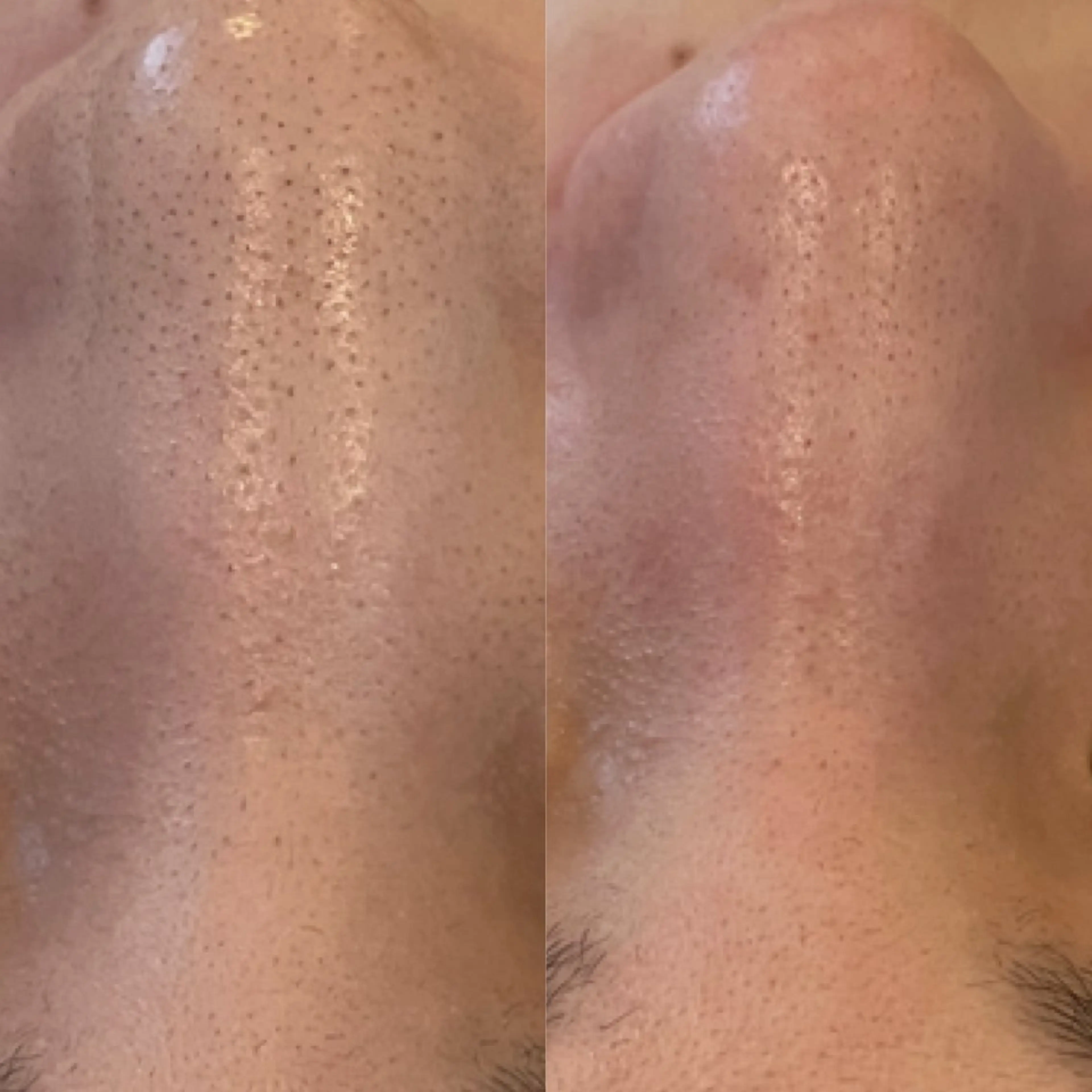 【4月先着10名様まで※残り5名様】どこでも1箇所お試しエクストラクション¥5500の写真