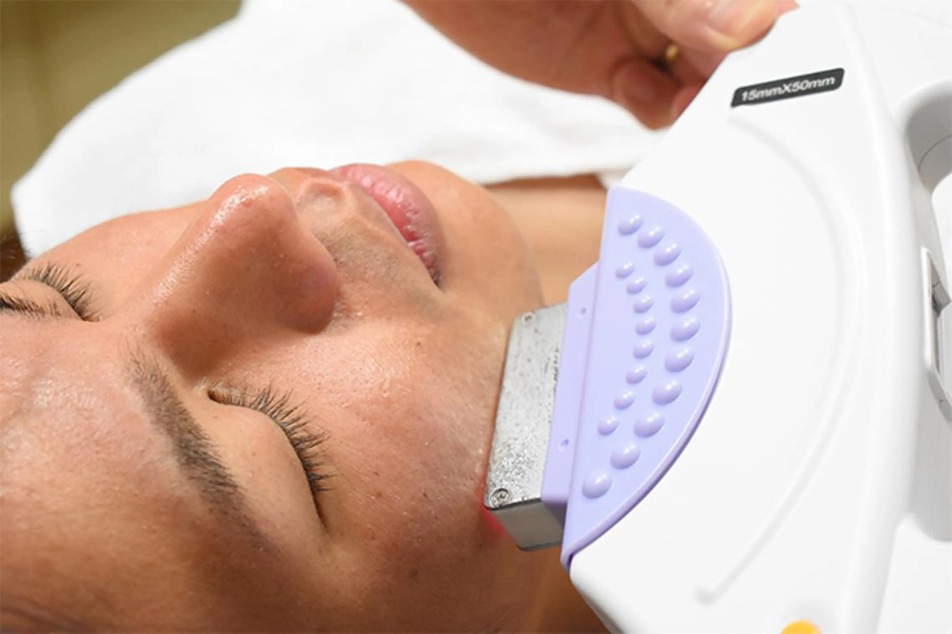 美肌メンズヒゲ脱毛♪の写真