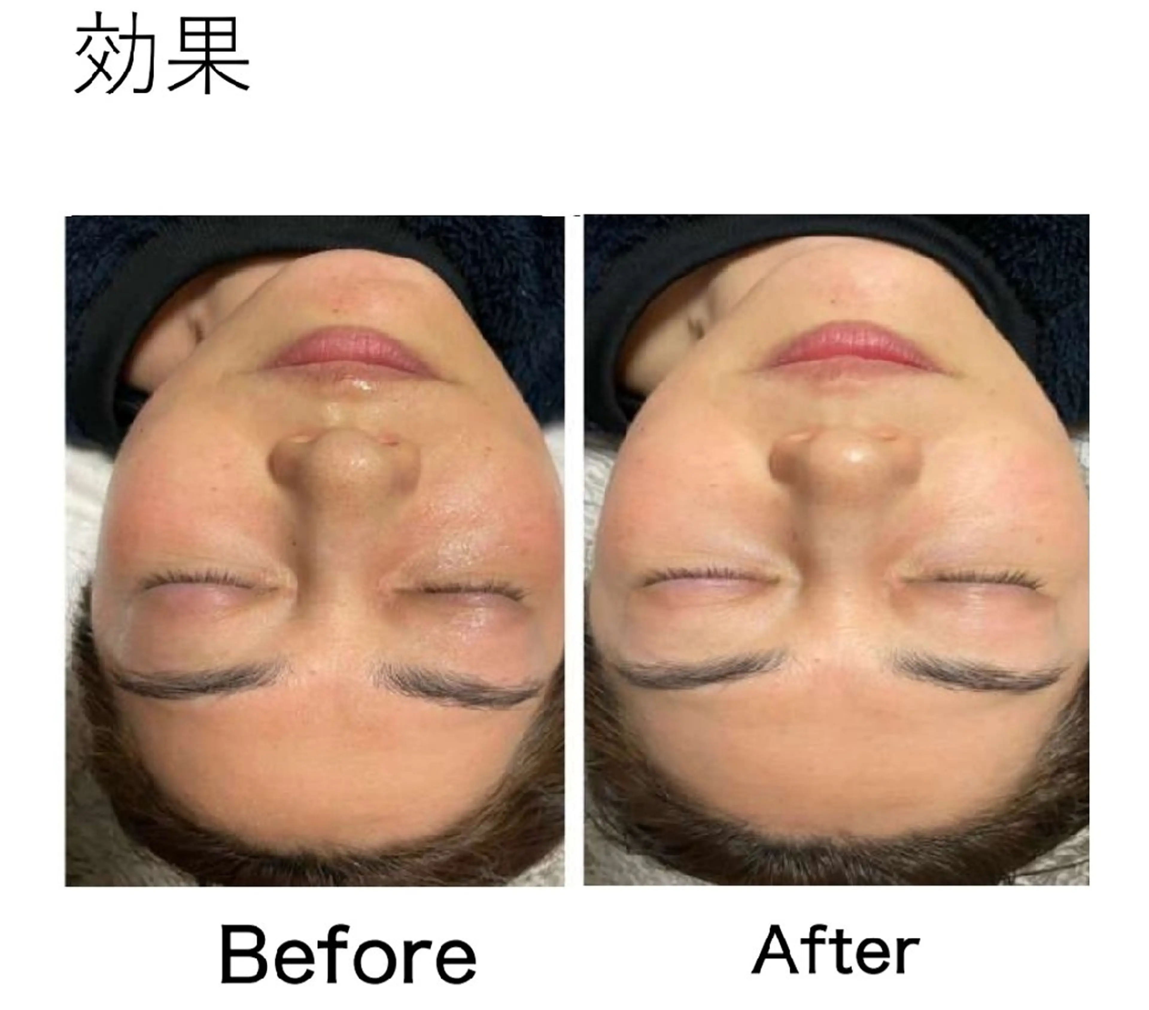 優しい剥離なしのハーブピーリング➕人幹細胞美容液をたっぷり入れこんでいきます。【現金のみ】の写真