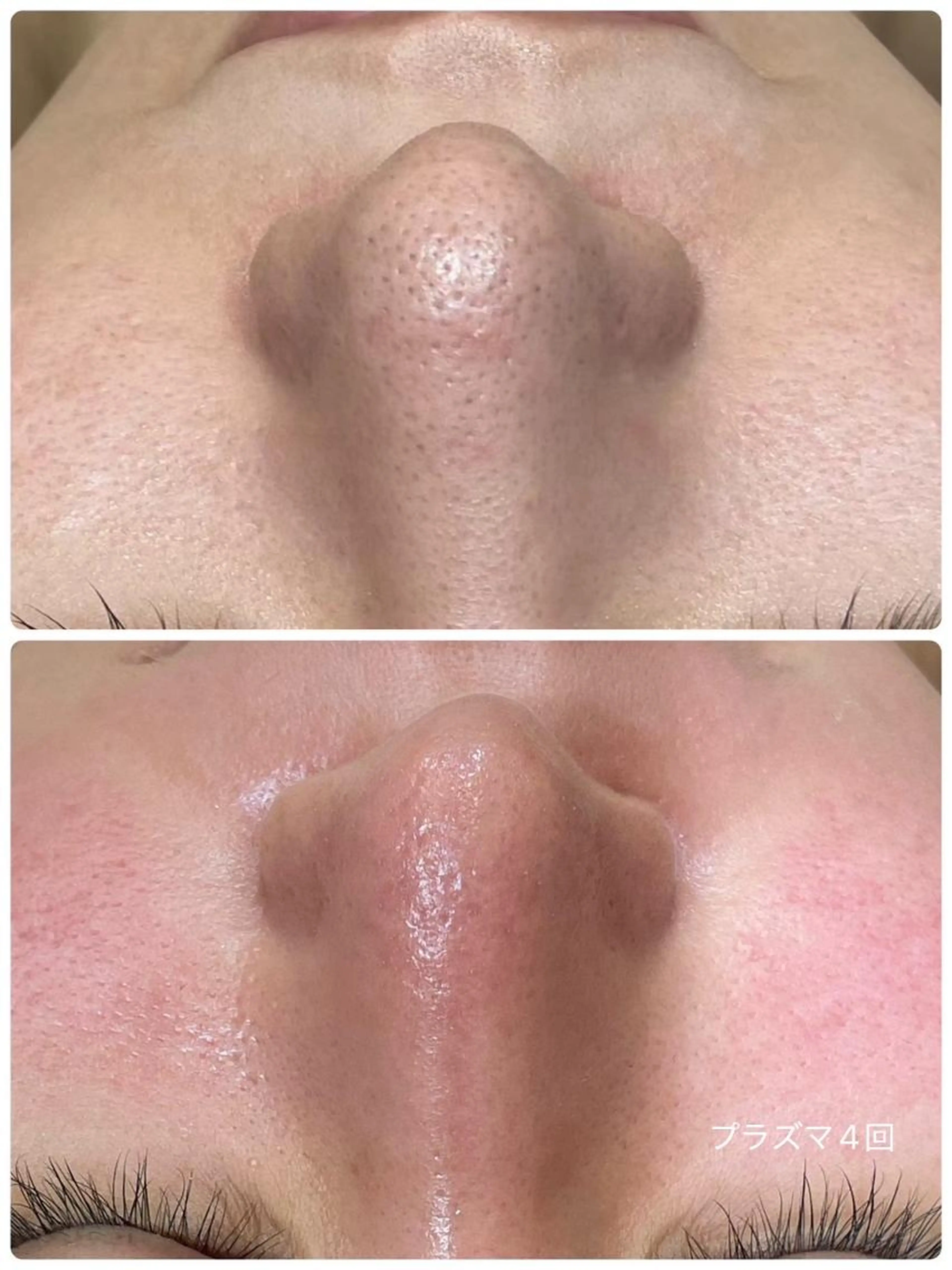 ✨人気No１✨フォト×顔脱毛【毛穴×ニキビ×乾燥×シミ×しわ×たるみ×くすみ×赤み×リフトUP】結果重視フォト脱毛✨の写真