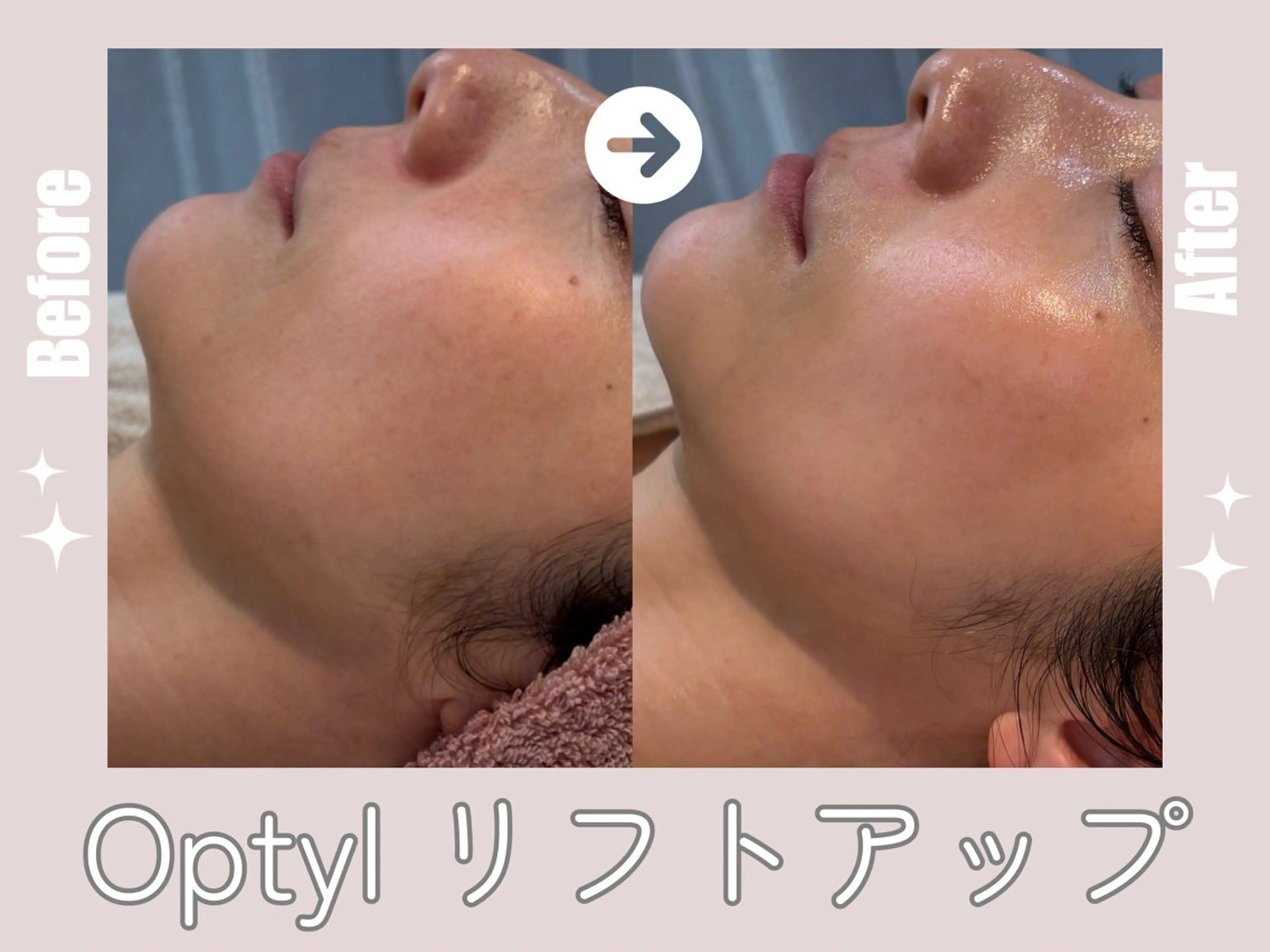 【症例モデル募集】最新LDM★水玉リフティング(オプティル)【肌質問わず男女OK】施術は約45分の写真