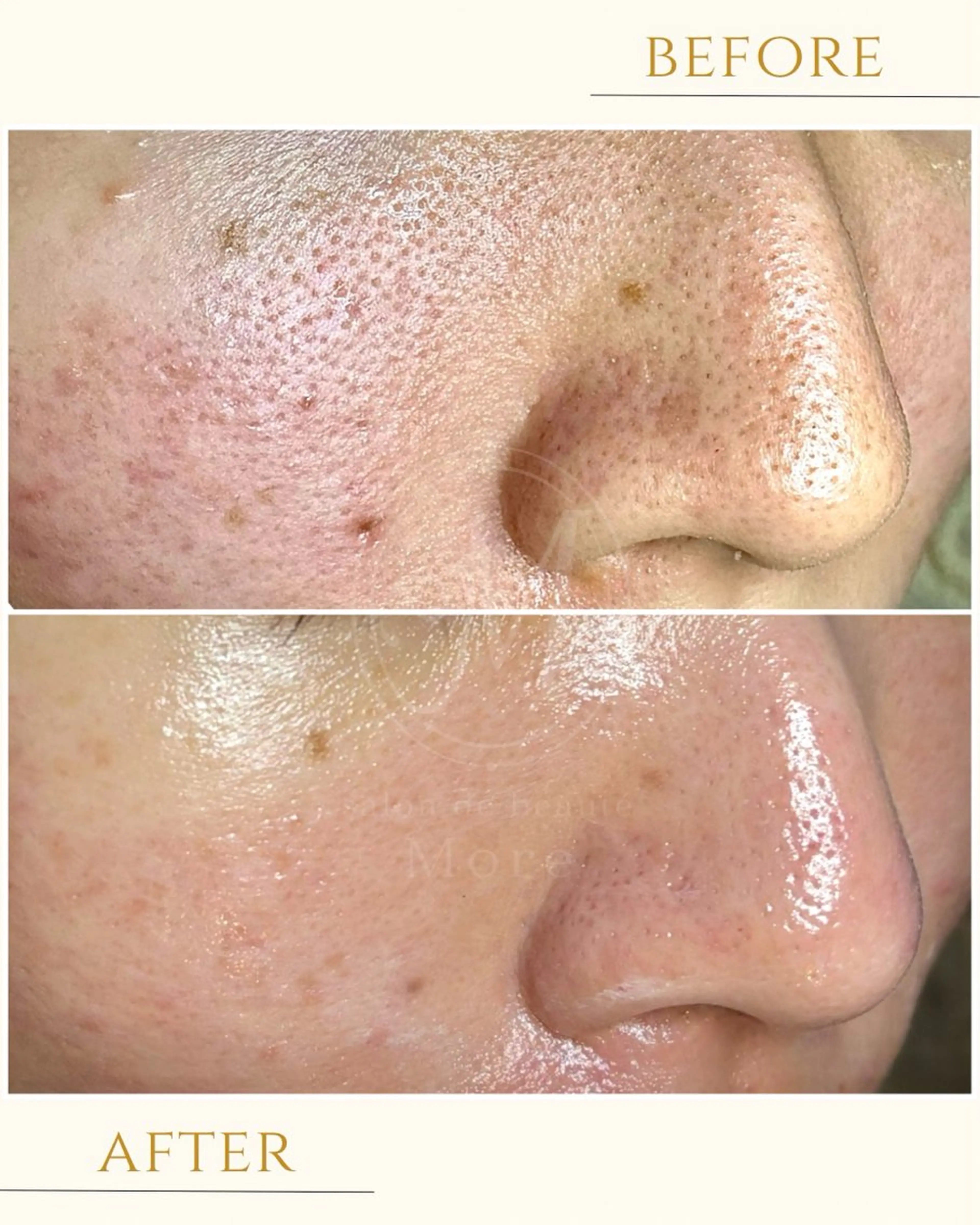 人気No. 1 毛穴×幹細胞ハーブピーリング or jピーリング×最新機器美容液導入 120分の写真